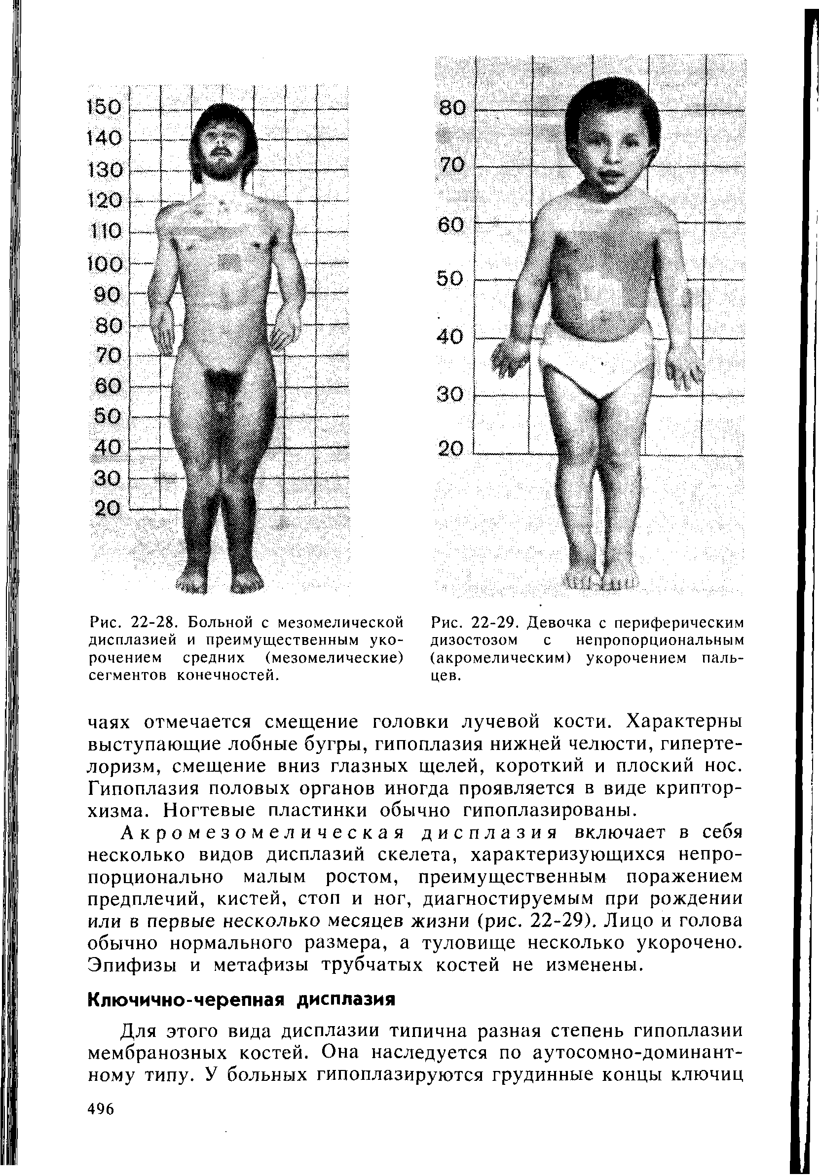 Рис. 22-29. Девочка с периферическим дизостозом с непропорциональным (акромелическим) укорочением пальцев.