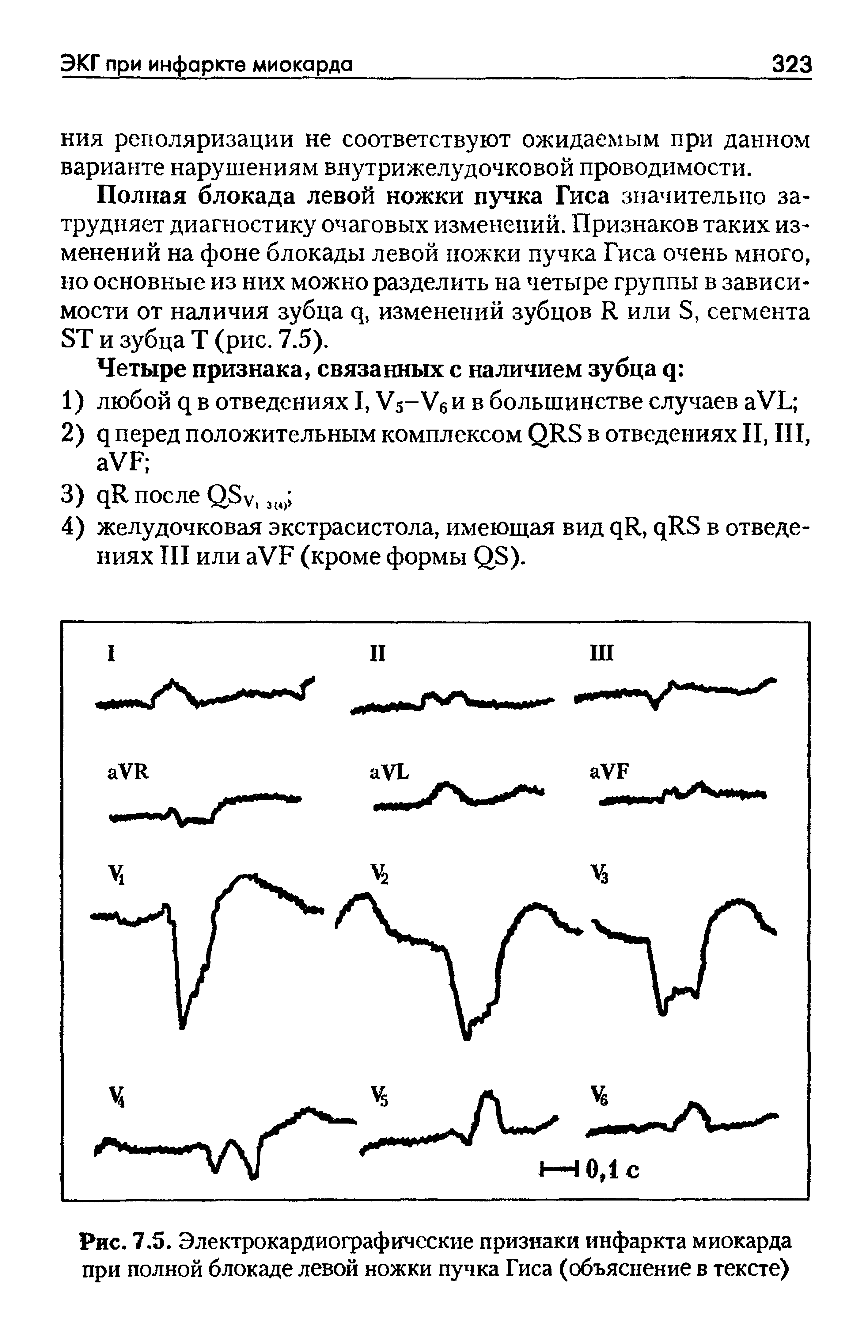 Рис. 7.5. Электрокардиографические признаки инфаркта миокарда при полной блокаде левой ножки пучка Гиса (объяснение в тексте)...