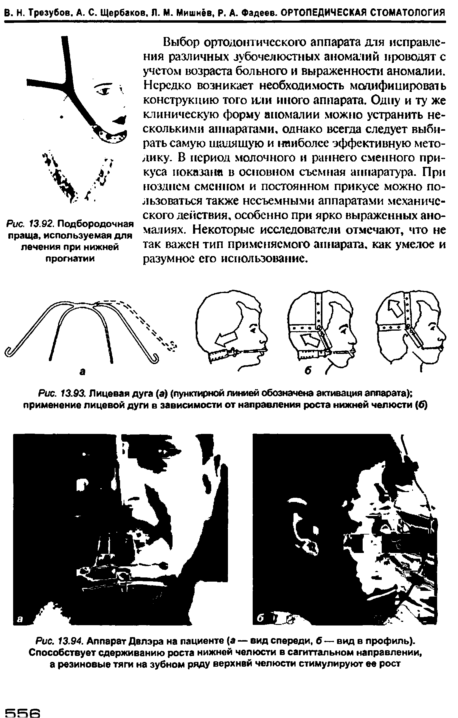 Рис. 13.93. Лицевая дуга (а) (пунктирной линией обозначена активация аппарата) применение лицевой дуги в зависимости от направления роста нижней челюсти (б)...