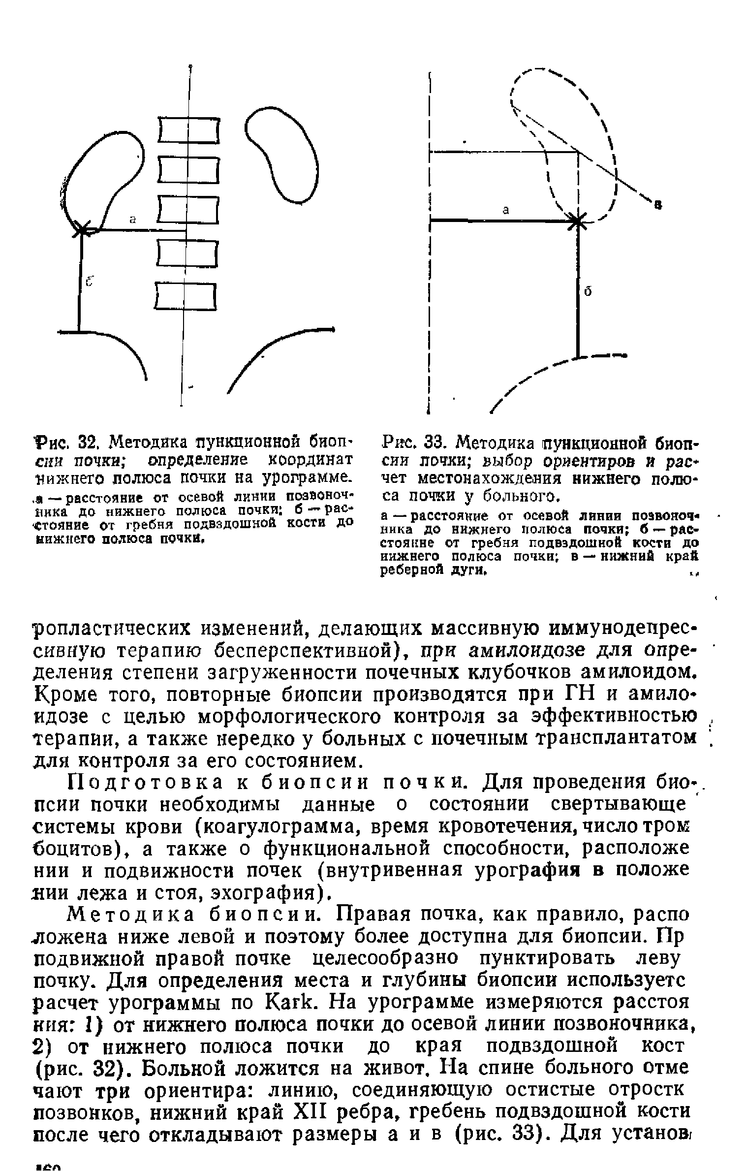 Рис. 33. Методика пункционной биопсии почки выбор ориентиров и расчет местонахождения нижнего полюса почки у больного.