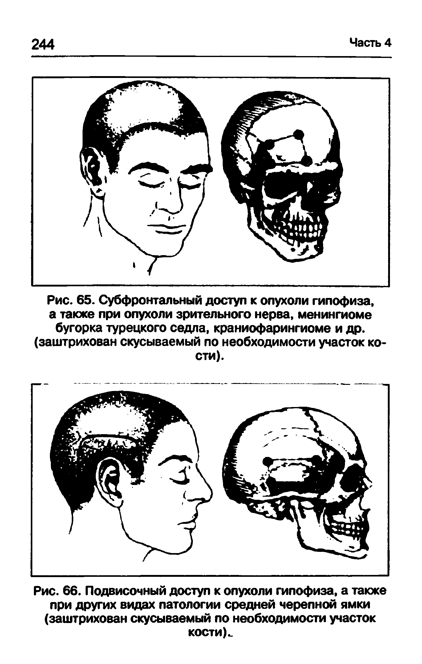 Рис. 66. Подвисочный доступ к опухоли гипофиза, а также при других видах патологии средней черепной ямки (заштрихован скусываемый по необходимости участок кости)..