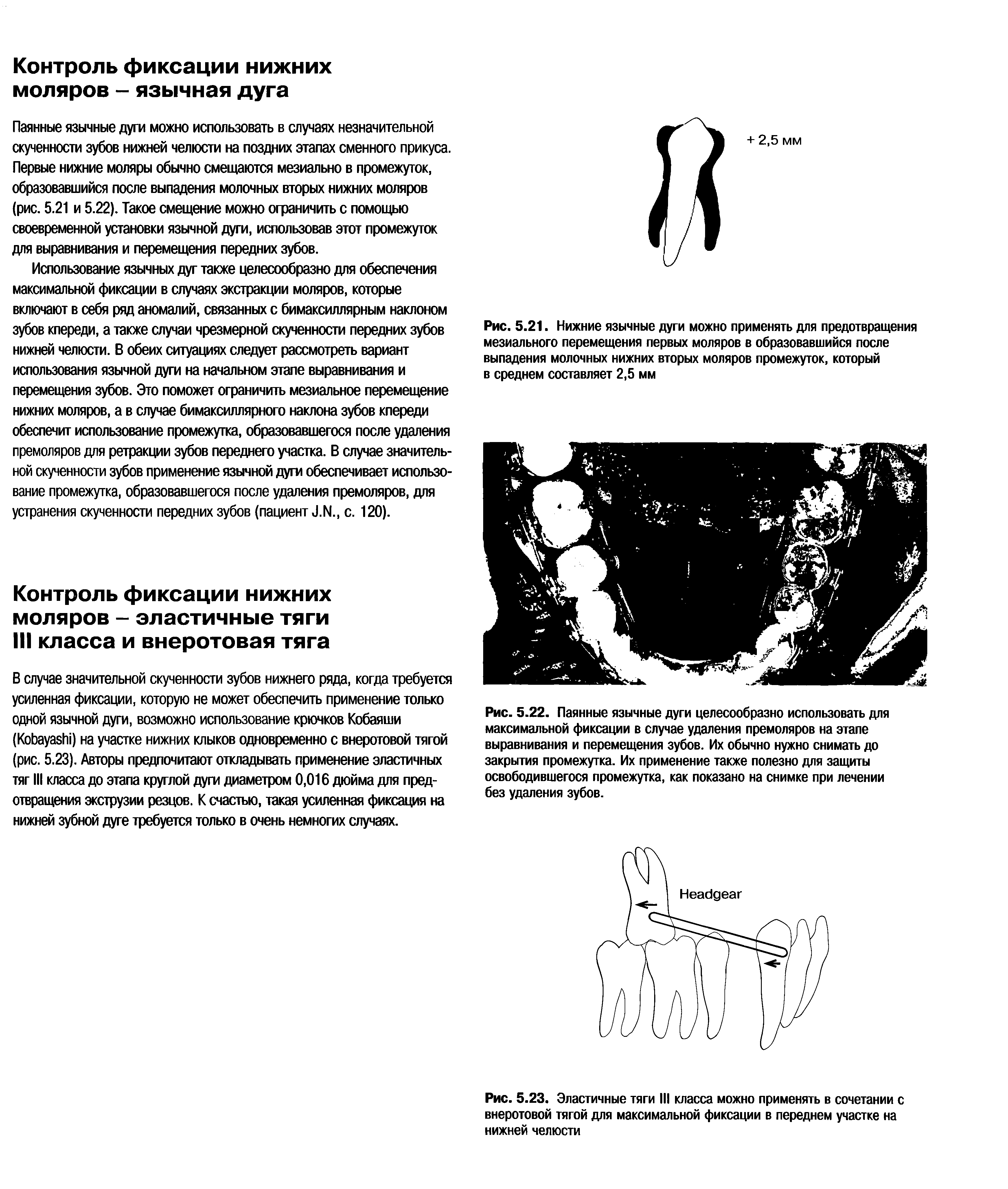 Рис. 5.23. Эластичные тяги III класса можно применять в сочетании с внеротовой тягой для максимальной фиксации в переднем участке на нижней челюсти...
