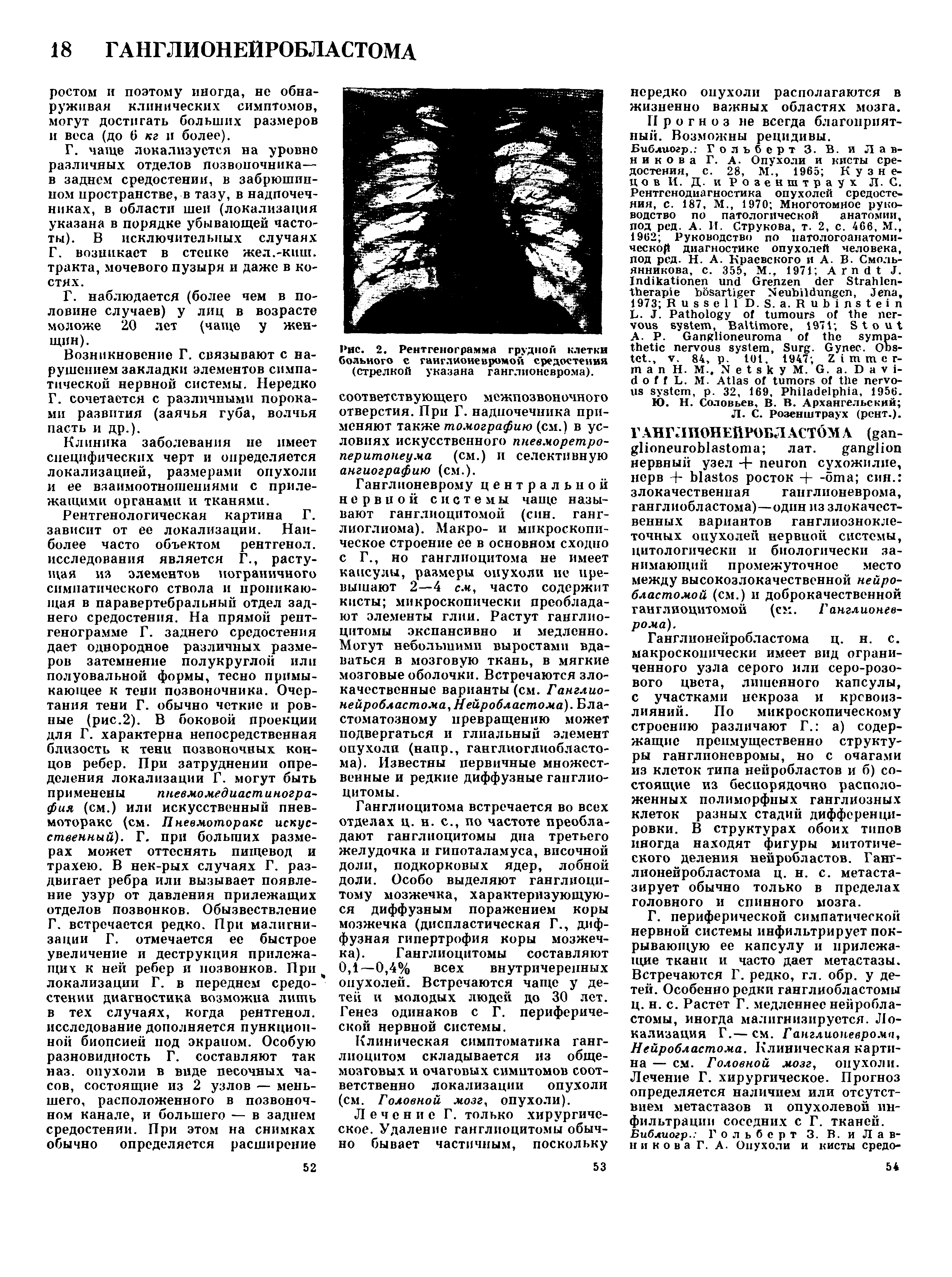 Рис. 2. Рентгенограмма грудной клетки больного с ганглионевромой средостения (стрелкой указана ганглионеврома).