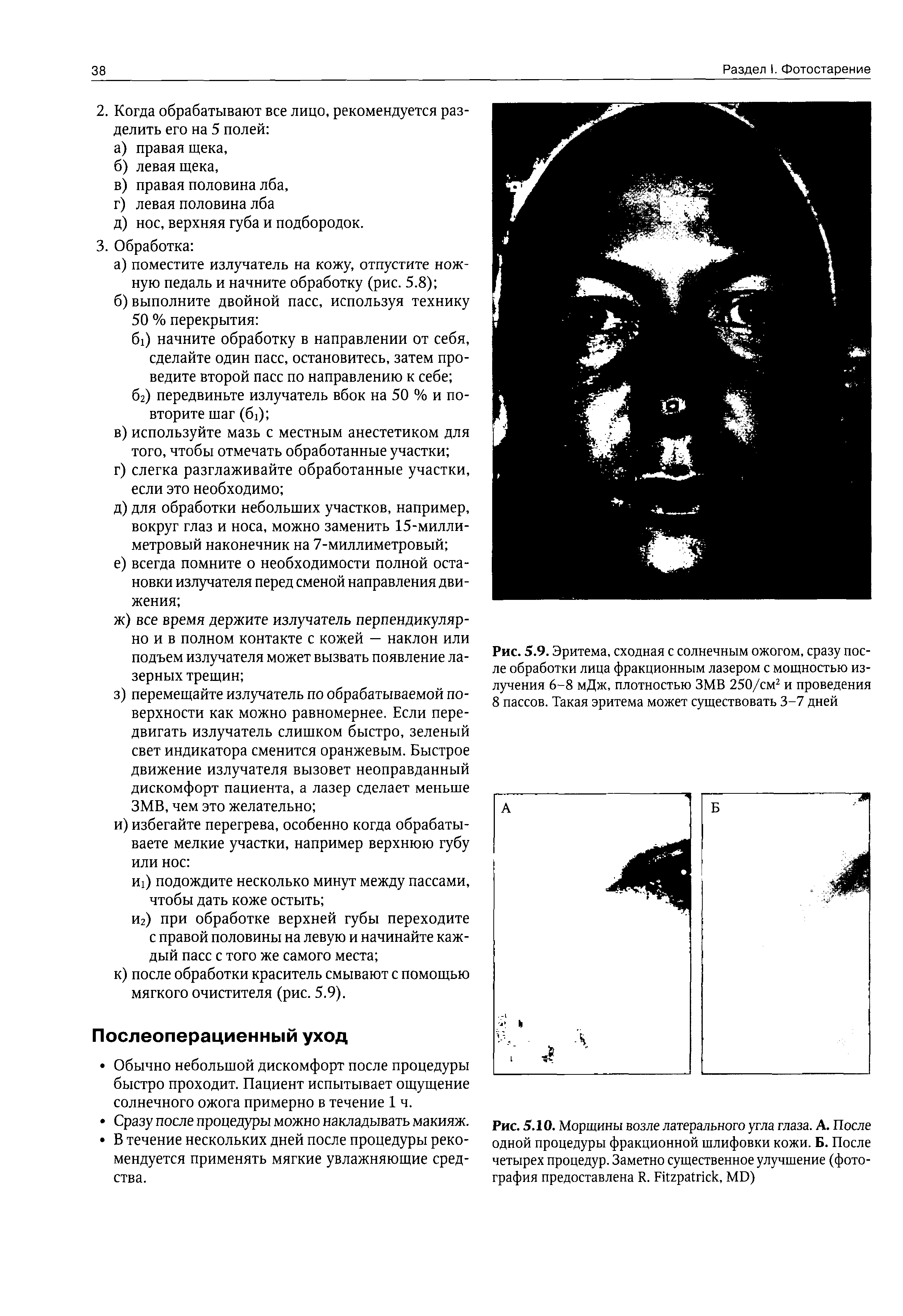 Рис. 5.9. Эритема, сходная с солнечным ожогом, сразу после обработки лица фракционным лазером с мощностью излучения 6-8 мДж, плотностью ЗМВ 250/см2 и проведения 8 пассов. Такая эритема может существовать 3-7 дней...