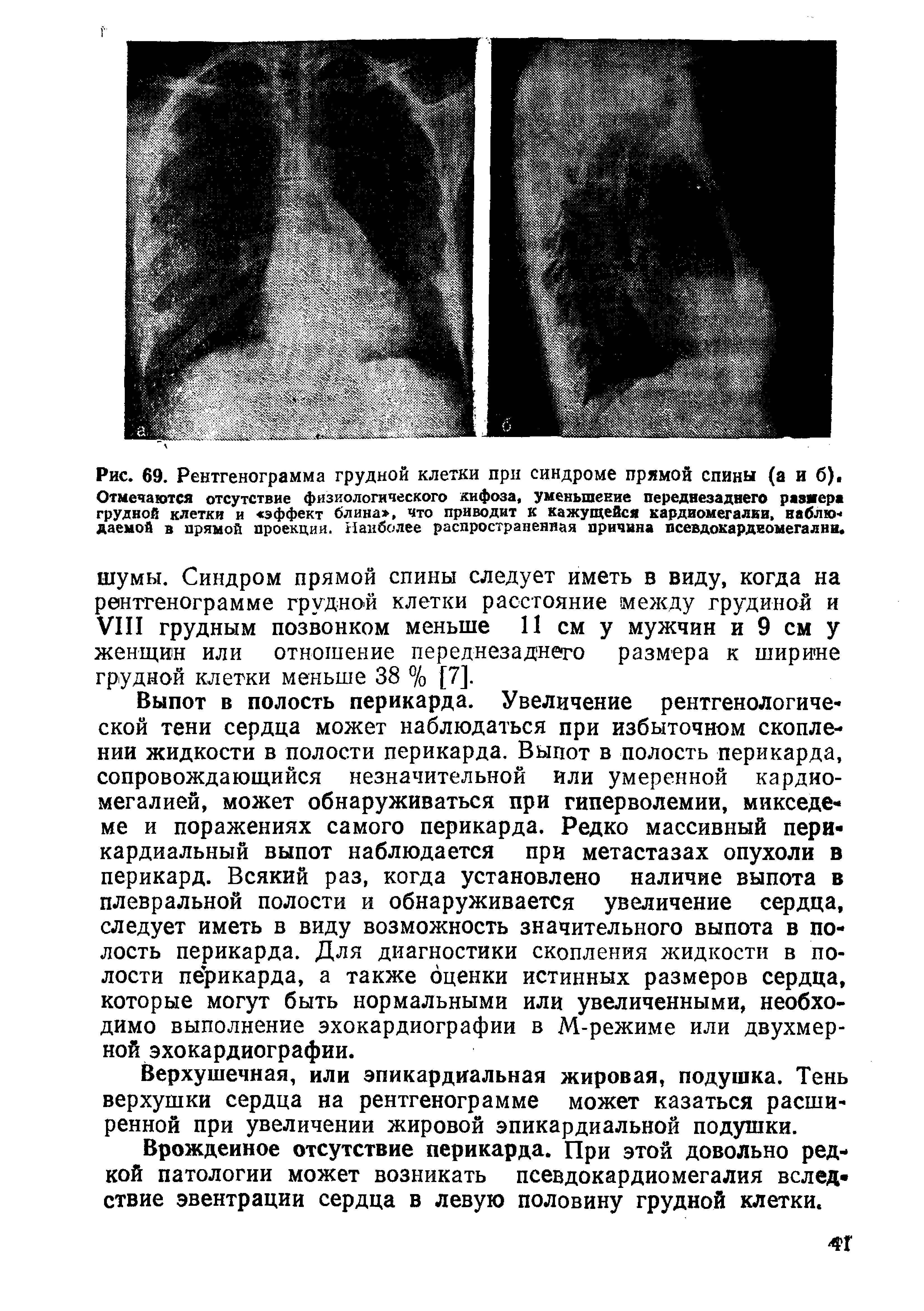 Рис. 69. Рентгенограмма грудной клетки при синдроме прямой спины (а и б). Отмечаются отсутствие физиологического кифоза уменьшение переднезаднего размера грудной клетки и эффект блина , что приводит к кажущейся к ар диомег алии, наблю- даемой в прямой проекции. Наиболее распространенная причина псевдокардкомегални.