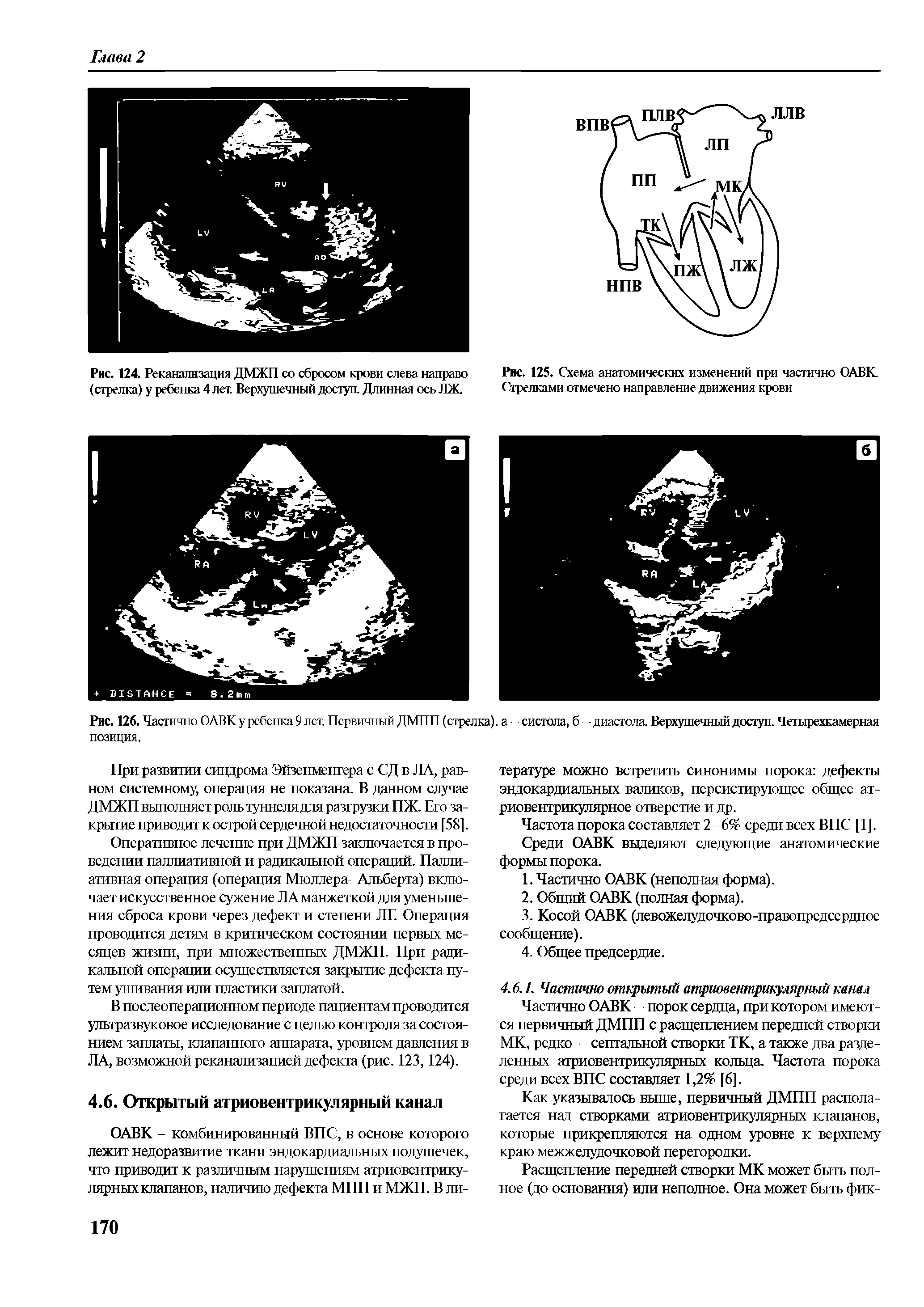 Рис. 126. Частично ОАВК у ребенка 9 лет. Первичный ДМПП (стрелка). а систола, б диастола. Верхушечный доступ. Четырехкамерная позиция.