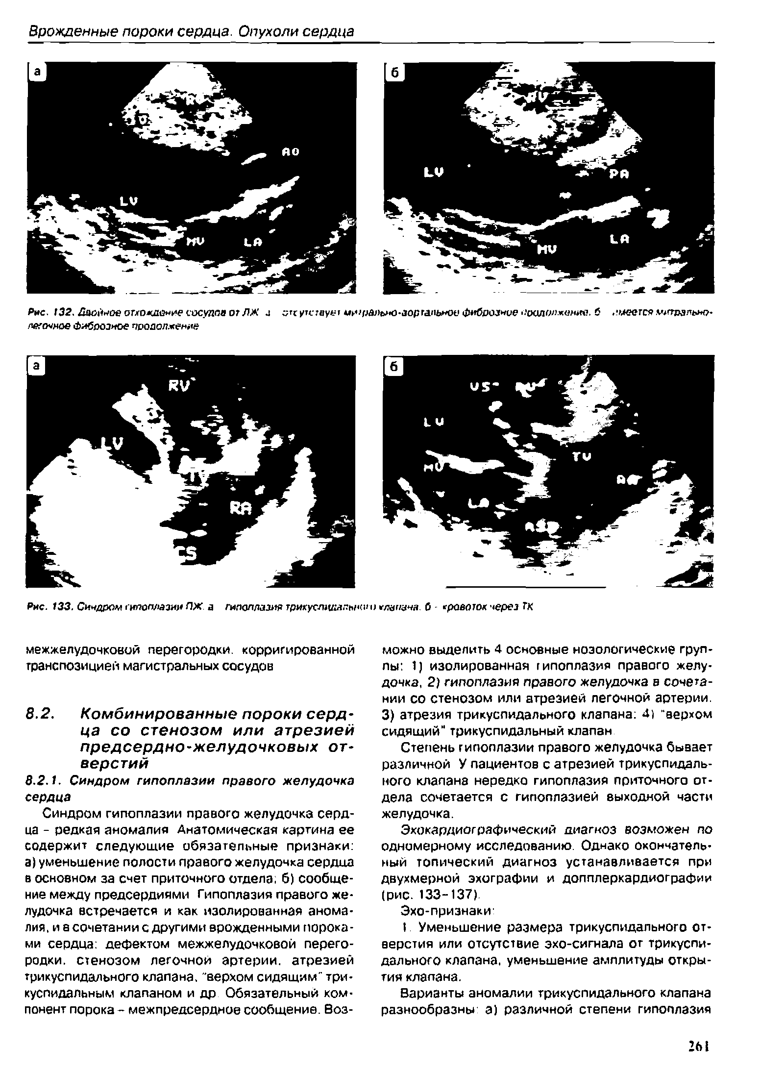 Рис. 133. Снчдром г иг ол/ эю ЛЖ а гипоплазия трикуслщяяыми лапана, б - кровоток через ГК...