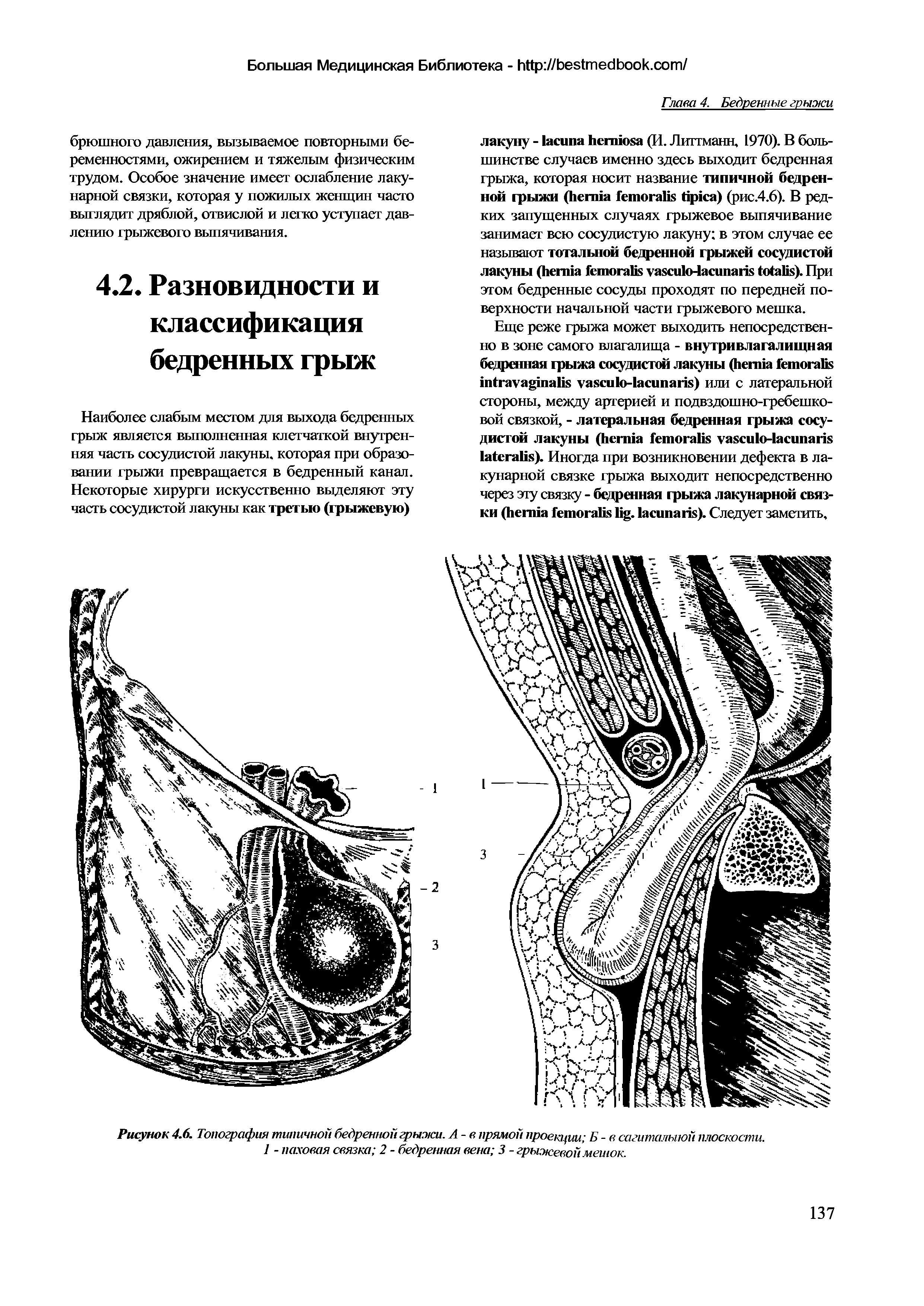 Рисунок 4.6. Топография типичной бедренной грыжи. А - в прямой проекции Б - в сагиталыюй плоскости.