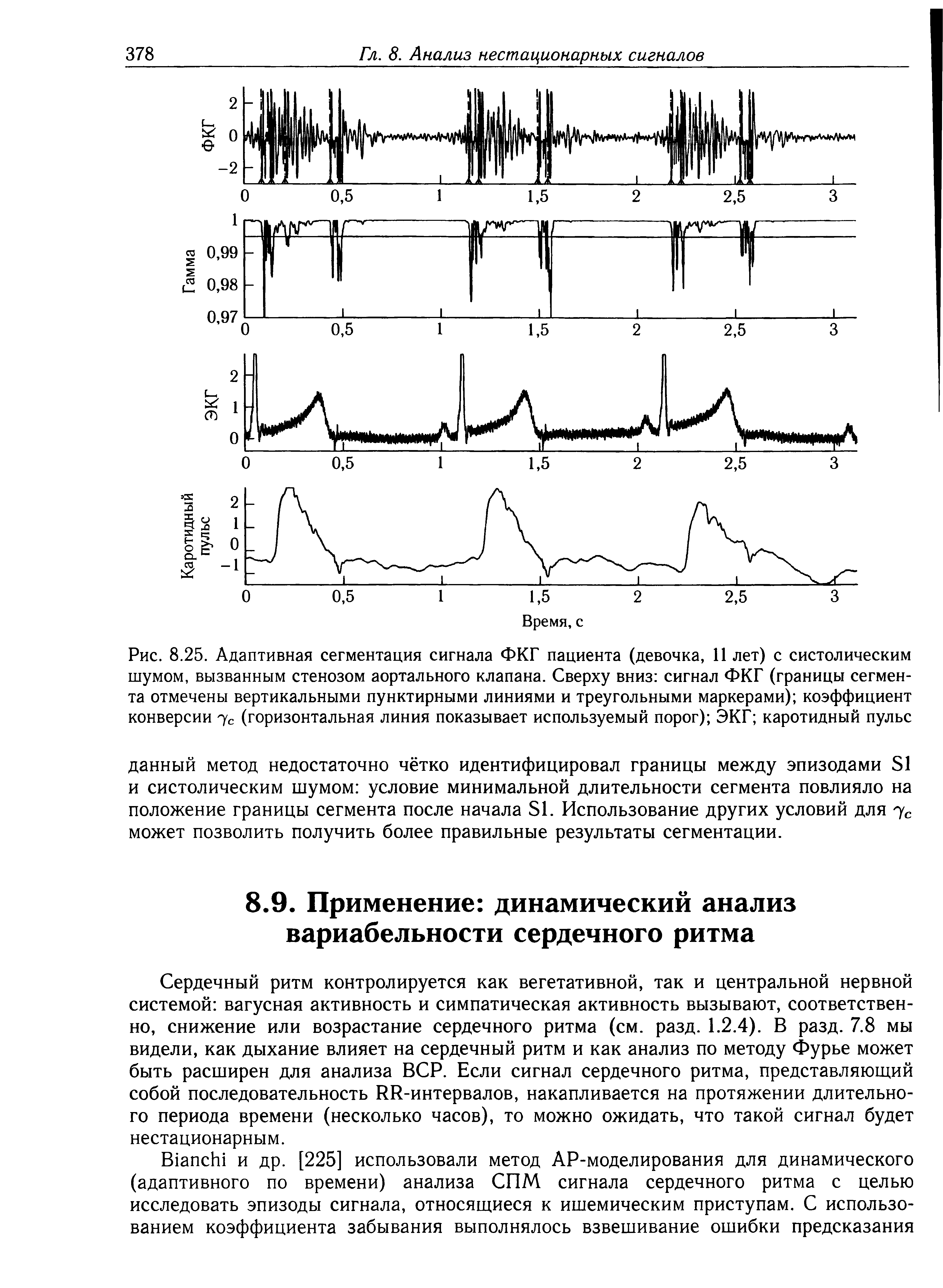 Рис. 8.25. Адаптивная сегментация сигнала ФКГ пациента (девочка, 11 лет) с систолическим шумом, вызванным стенозом аортального клапана. Сверху вниз сигнал ФКГ (границы сегмента отмечены вертикальными пунктирными линиями и треугольными маркерами) коэффициент конверсии 7с (горизонтальная линия показывает используемый порог) ЭКГ каротидный пульс...