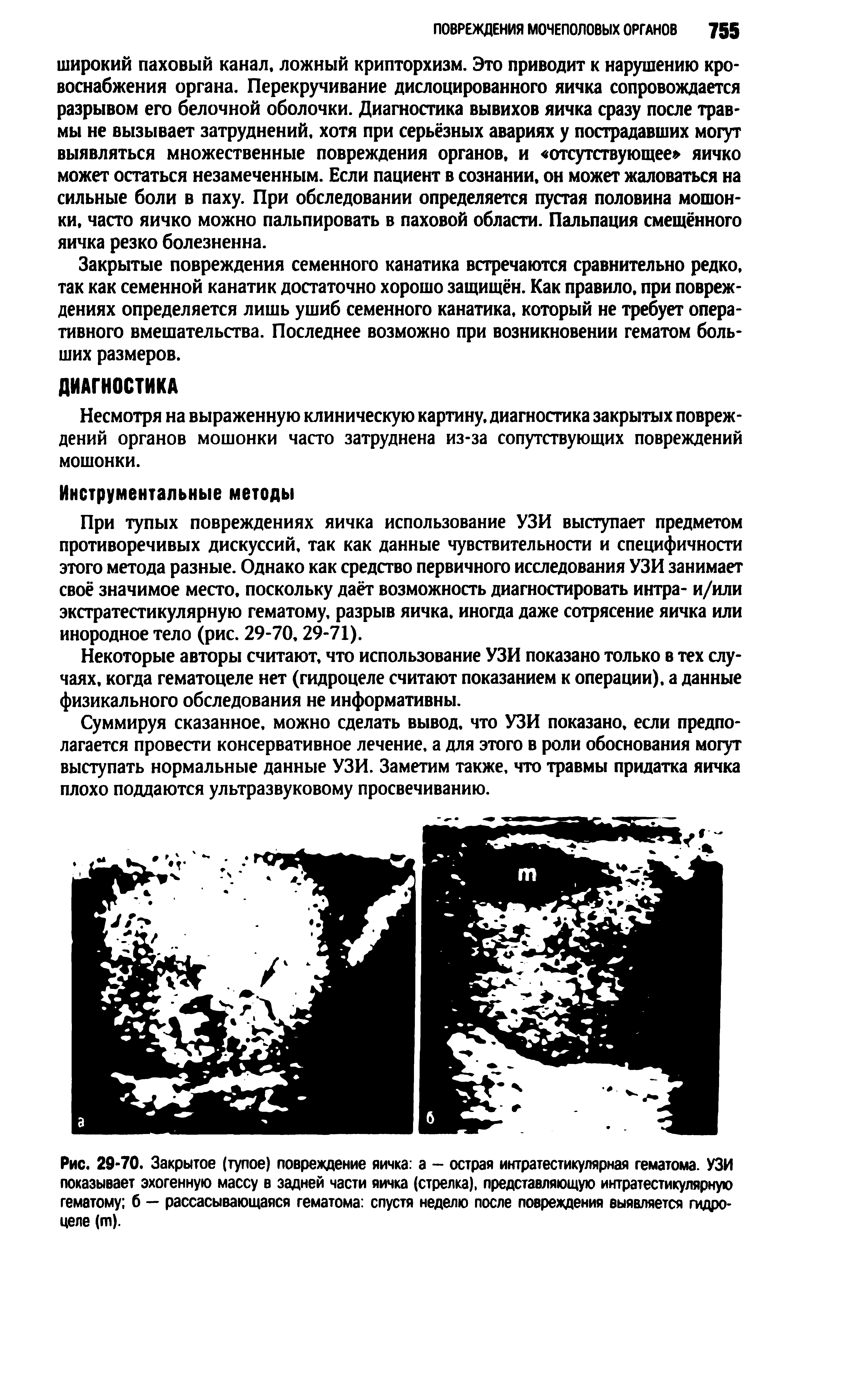 Рис. 29-70. Закрытое (тупое) повреждение яичка а - острая интратестикулярная гематома. УЗИ показывает эхогенную массу в задней части яичка (стрелка), представляющую интратестикулярную гематому б — рассасывающаяся гематома спустя неделю после повреждения выявляется гидроцеле (т).