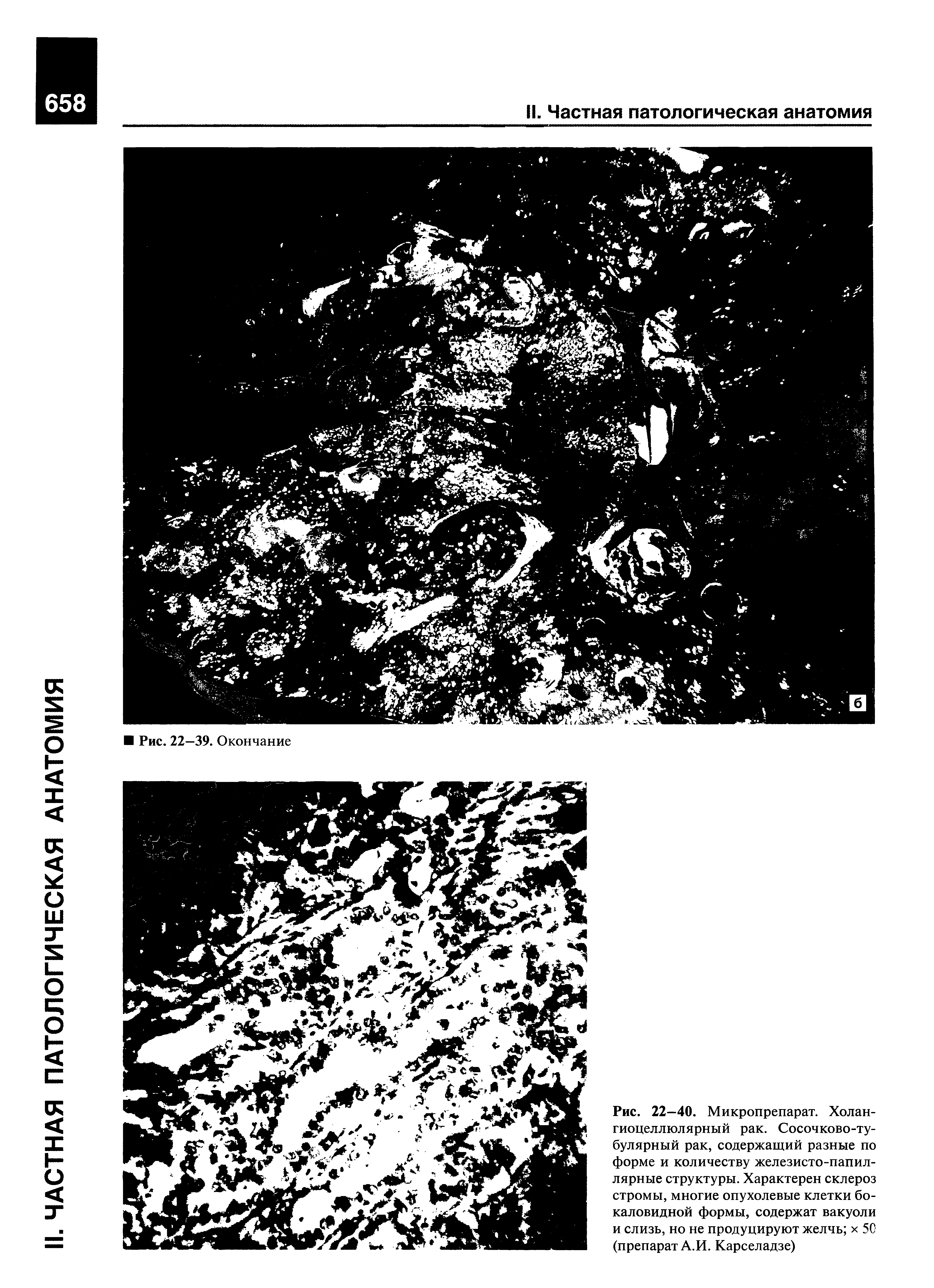 Рис. 22—40. Микропрепарат. Холан-гиоцеллюлярный рак. Сосочково-тубулярный рак, содержащий разные по форме и количеству железисто-папиллярные структуры. Характерен склероз стромы, многие опухолевые клетки бокаловидной формы, содержат вакуоли и слизь, но не продуцируют желчь х 50 (препарат А.И. Карселадзе)...