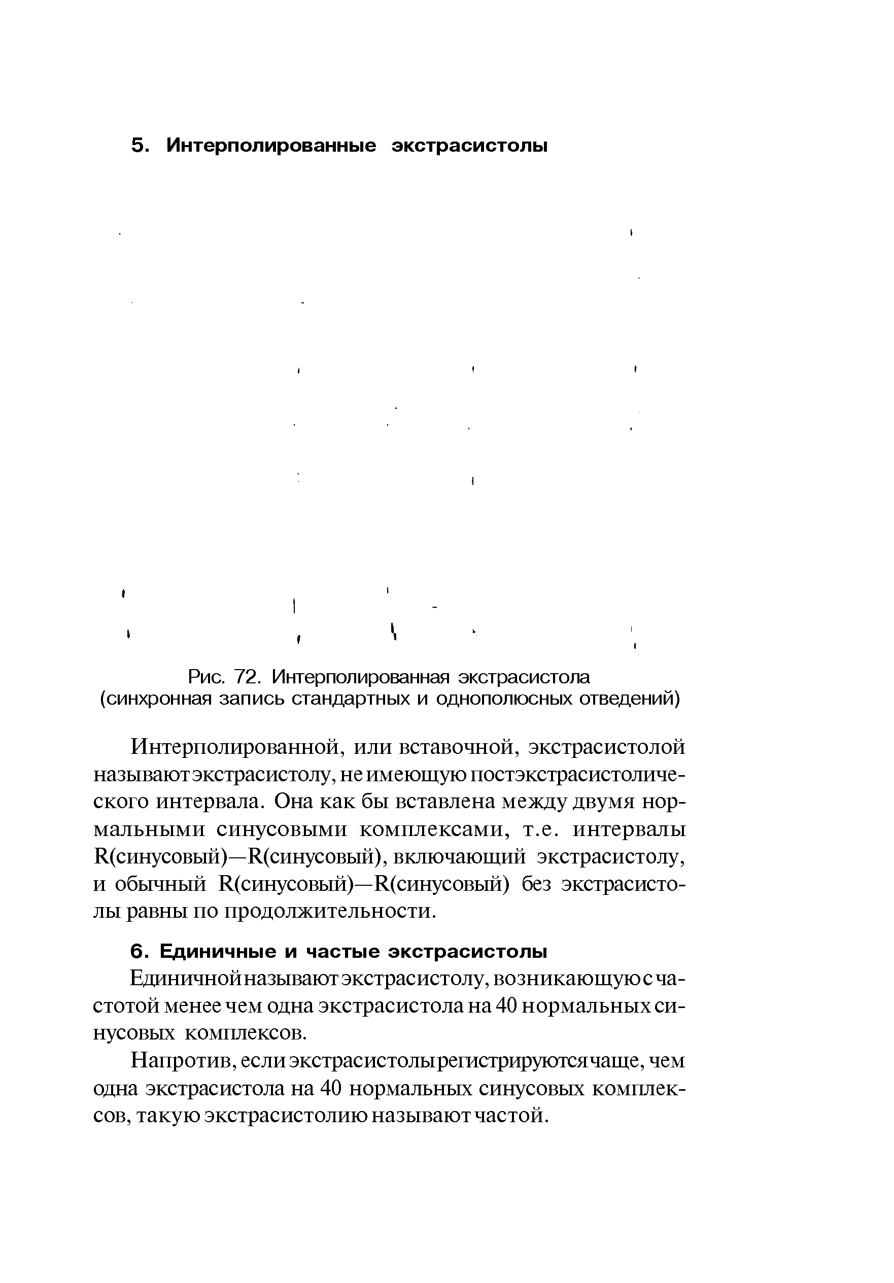 Рис. 72. Интерполированная экстрасистола (синхронная запись стандартных и однополюсных отведений)...