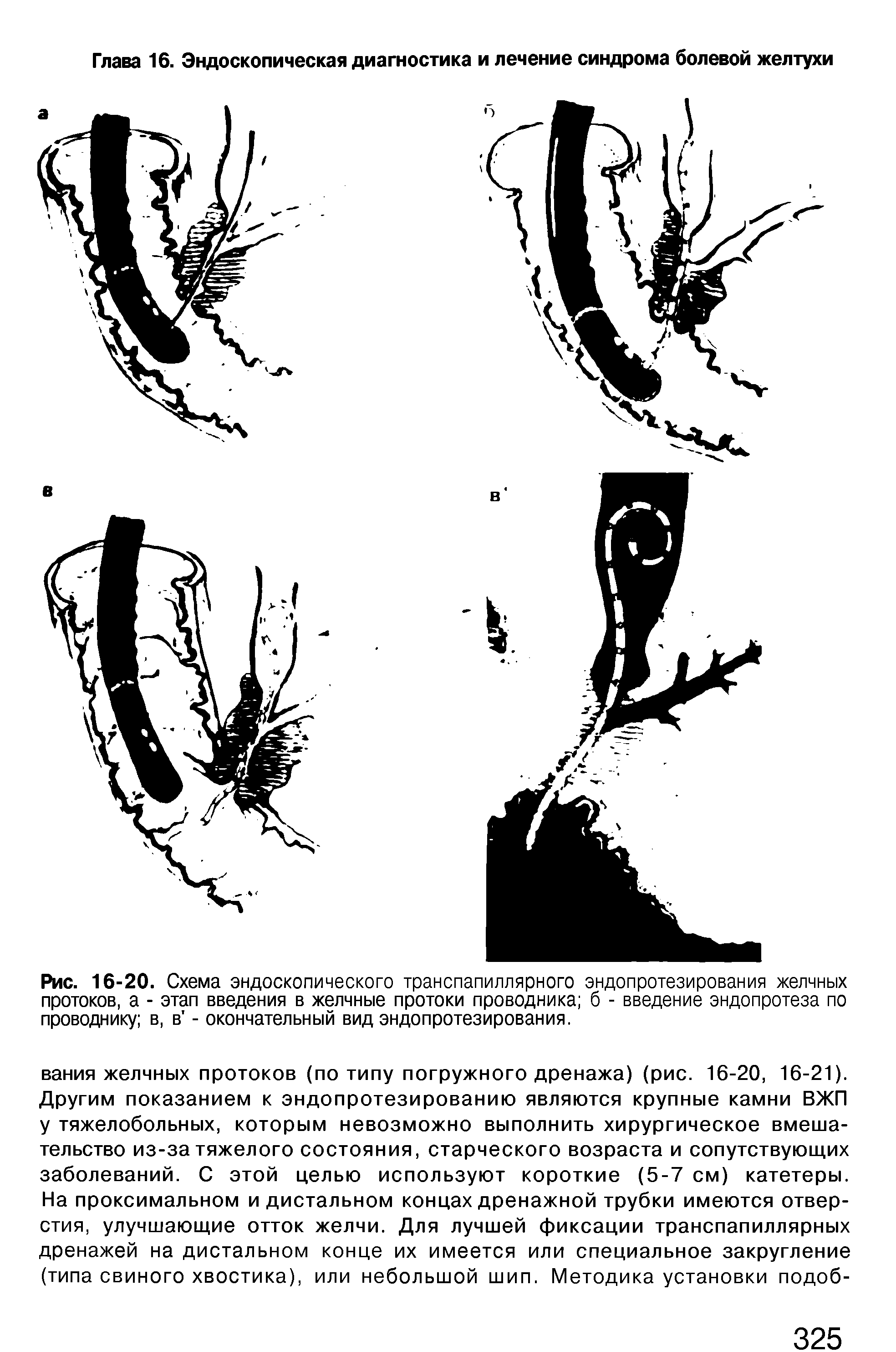 Рис. 16-20. Схема эндоскопического транспапиллярного эндопротезирования желчных протоков, а - этап введения в желчные протоки проводника б - введение эндопротеза по проводнику в, в - окончательный вид эндопротезирования.