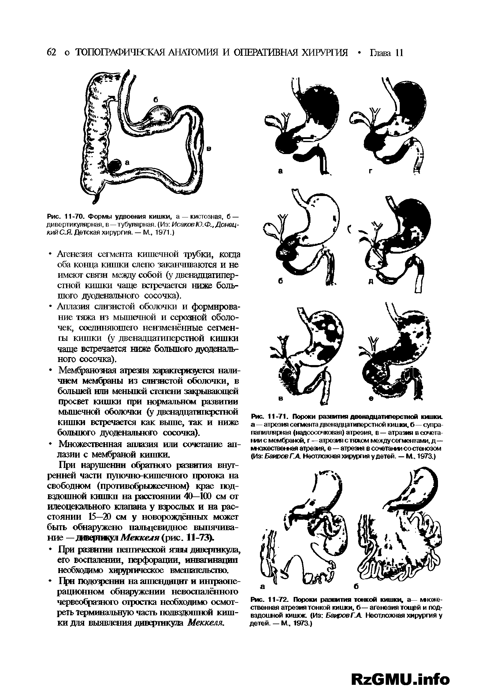 Рис. 11-72. Пороки развития тонкой кишки, а— кможе-ственная атрезиятонкой кишки, б— агенезия тощвй и подвздошной кишок. (Из Бажов Г. А. Неотложная хирургия у детей. — М., 1973.)...