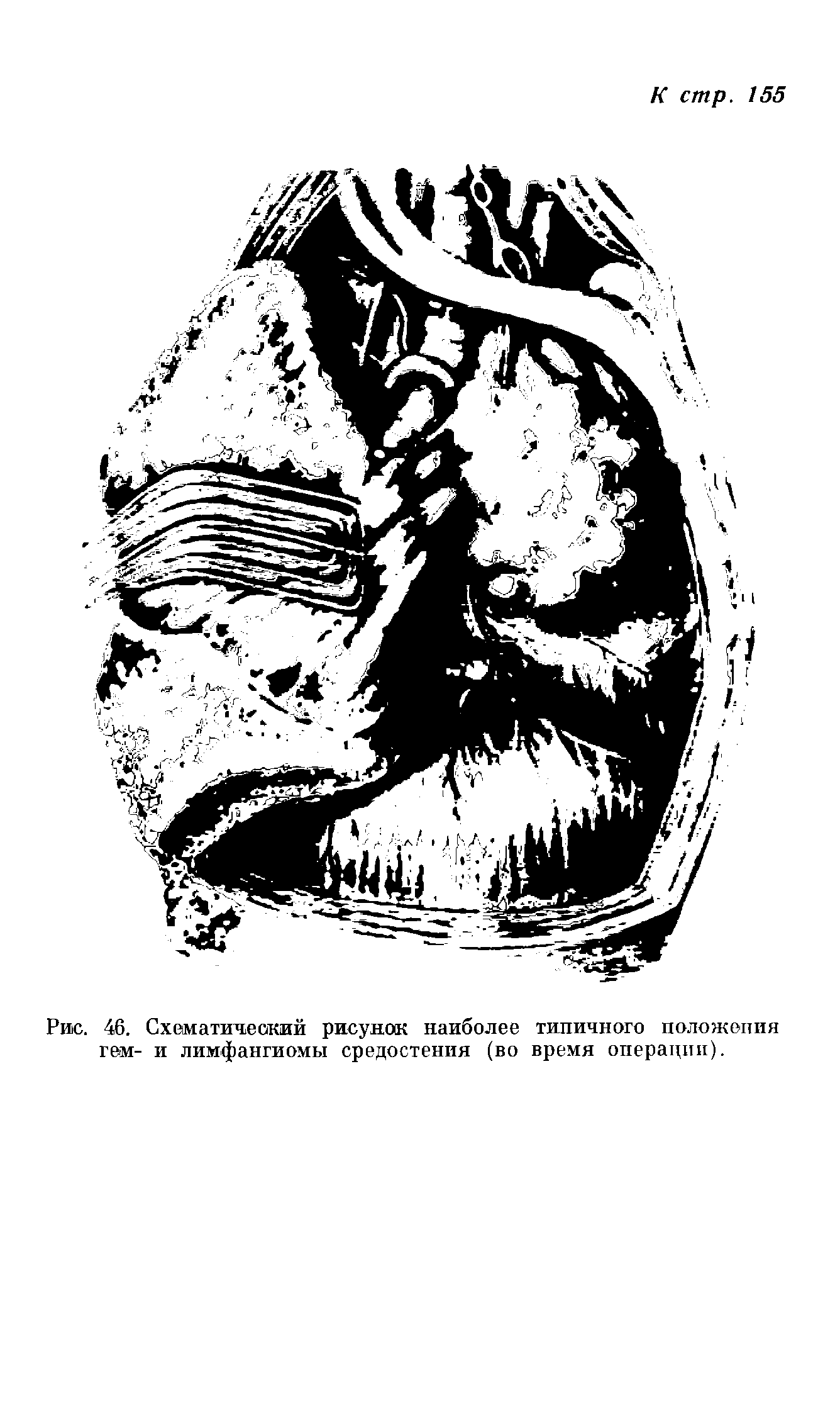 Рис. 46. Схематический рисунок наиболее типичного положения гем- и лимфангиомы средостения (во время операции).