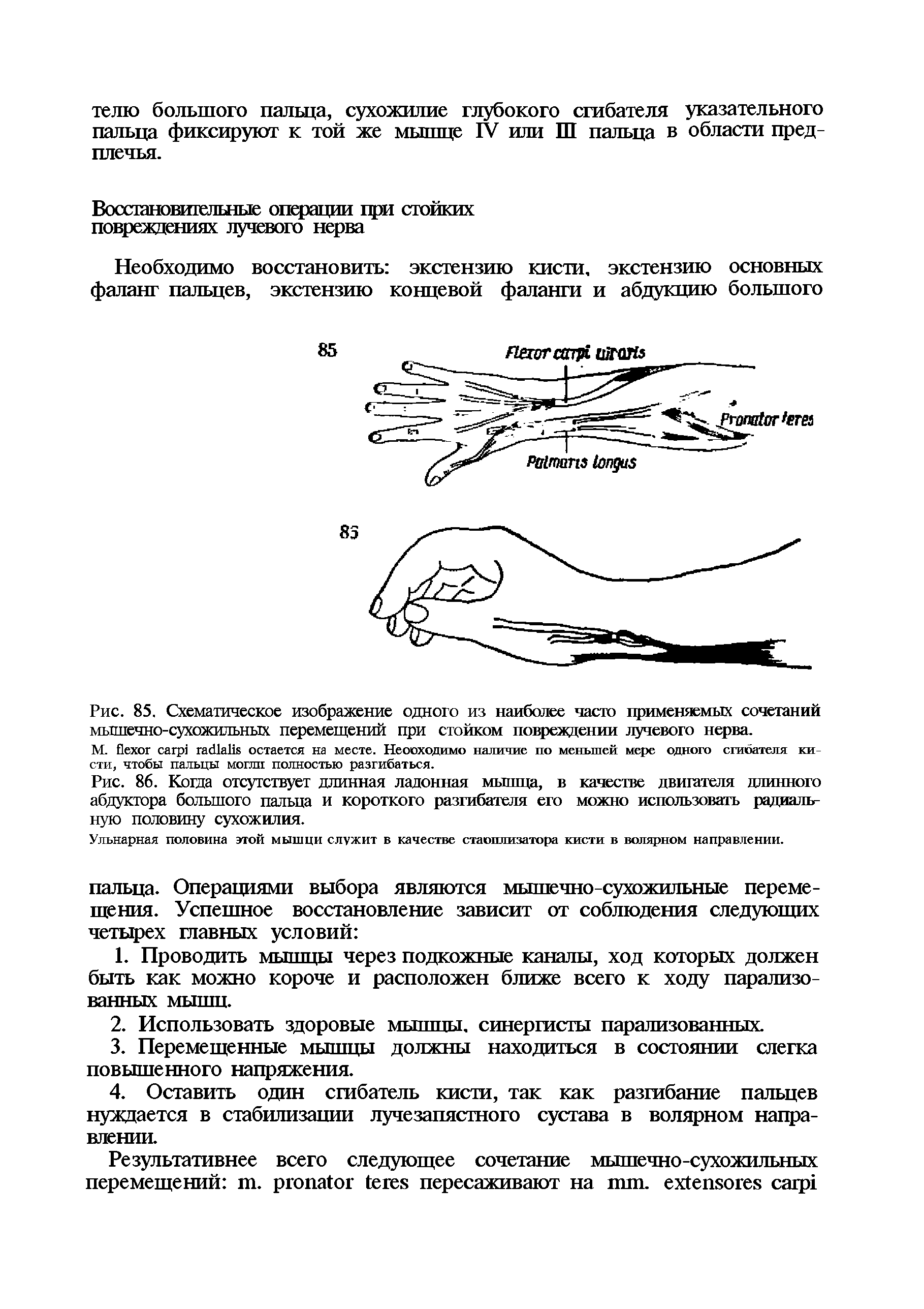 Рис. 86. Когда отсутствует длинная ладонная мышца, в качестве двигателя длинного абдуктора большого пальца и короткого разгибателя его можно использовать радиальную половину сухожилия.