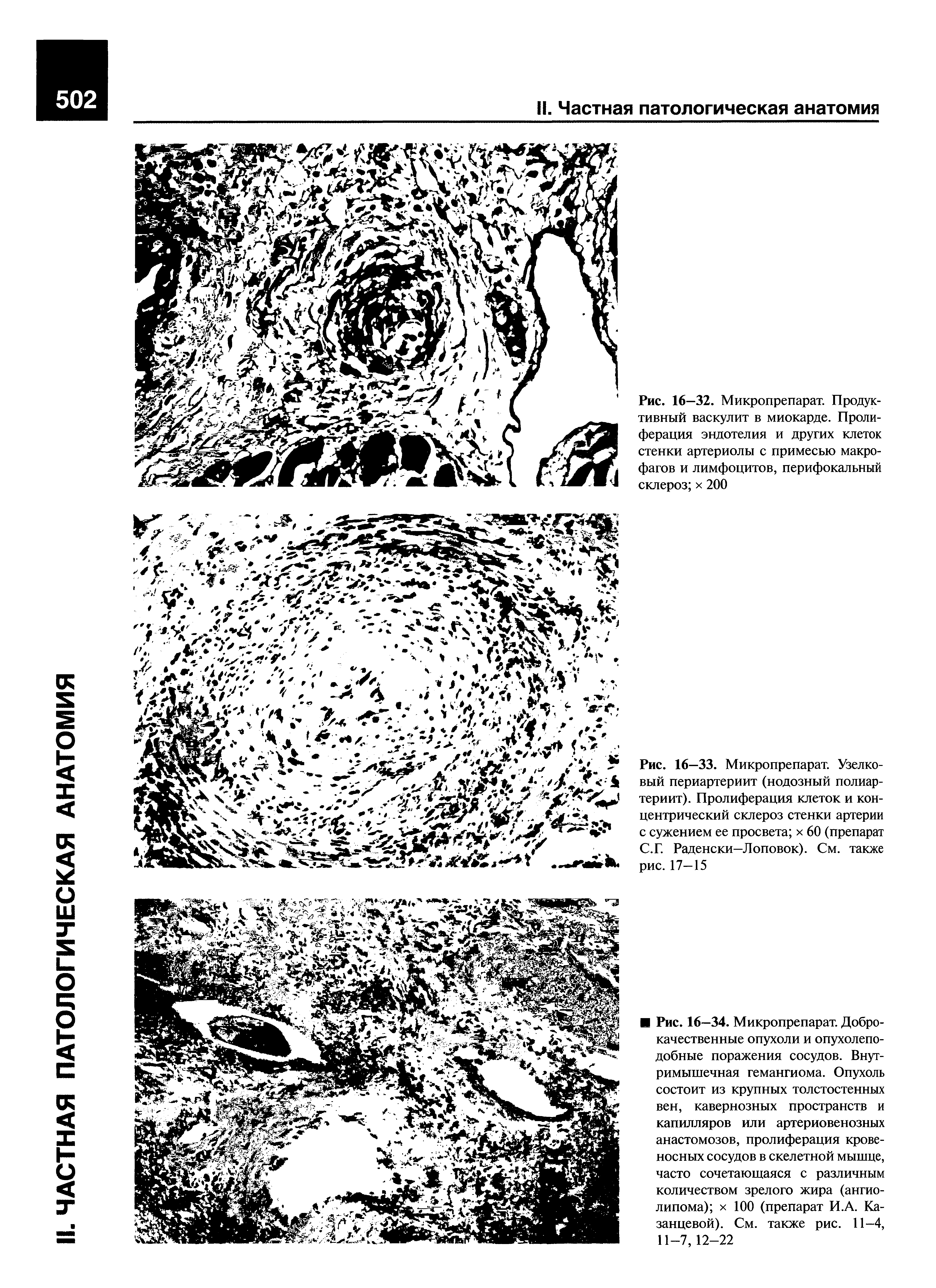Рис. 16—33. Микропрепарат. Узелковый периартериит (нодозный полиартериит). Пролиферация клеток и концентрический склероз стенки артерии с сужением ее просвета х 60 (препарат С.Г. Раденски—Лоповок). См. также рис. 17—15...
