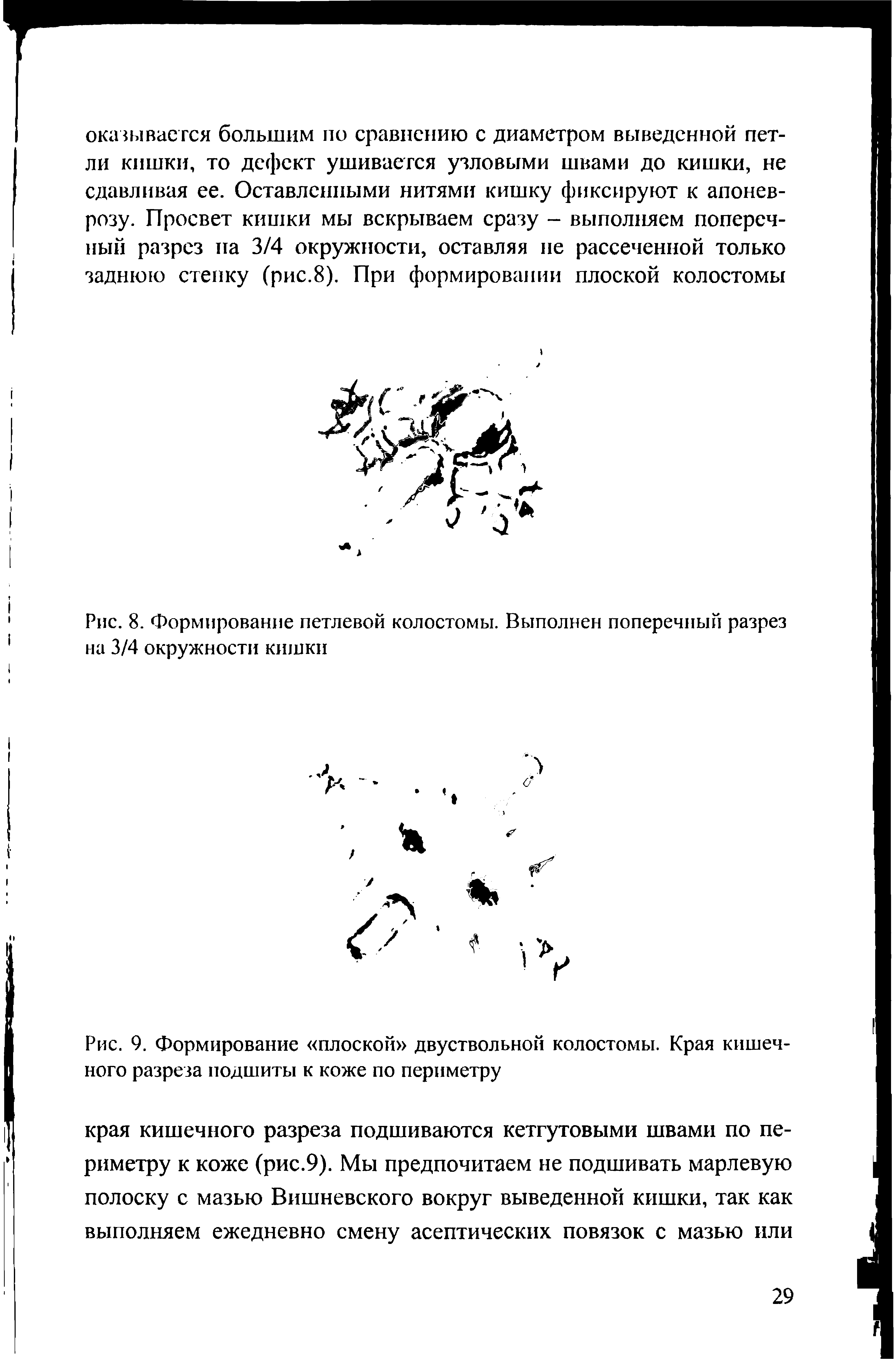 Рис. 9. Формирование плоской двуствольной колостомы. Края кишечного разреза подшиты к коже по периметру...