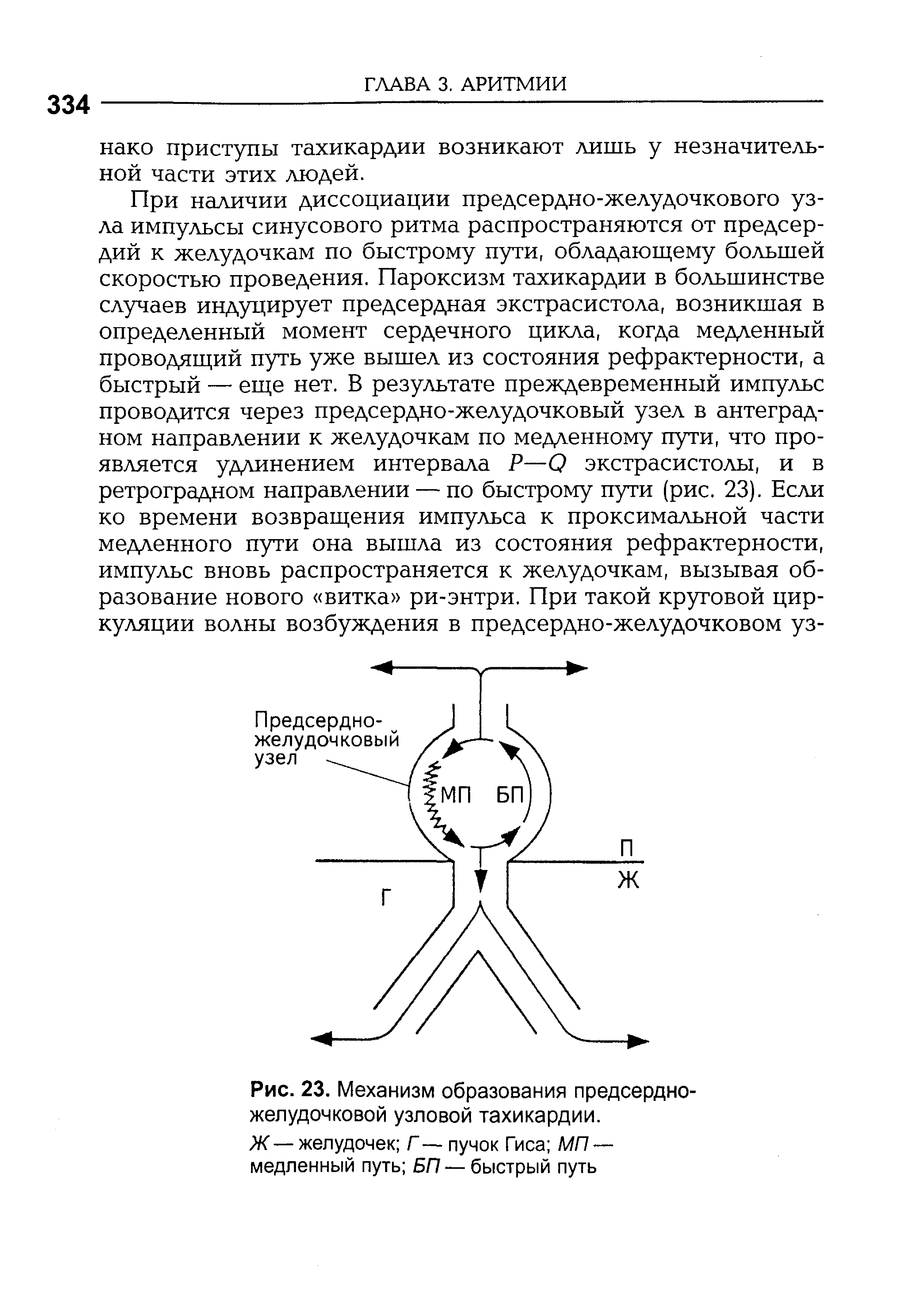 Рис. 23. Механизм образования предсердно-желудочковой узловой тахикардии.