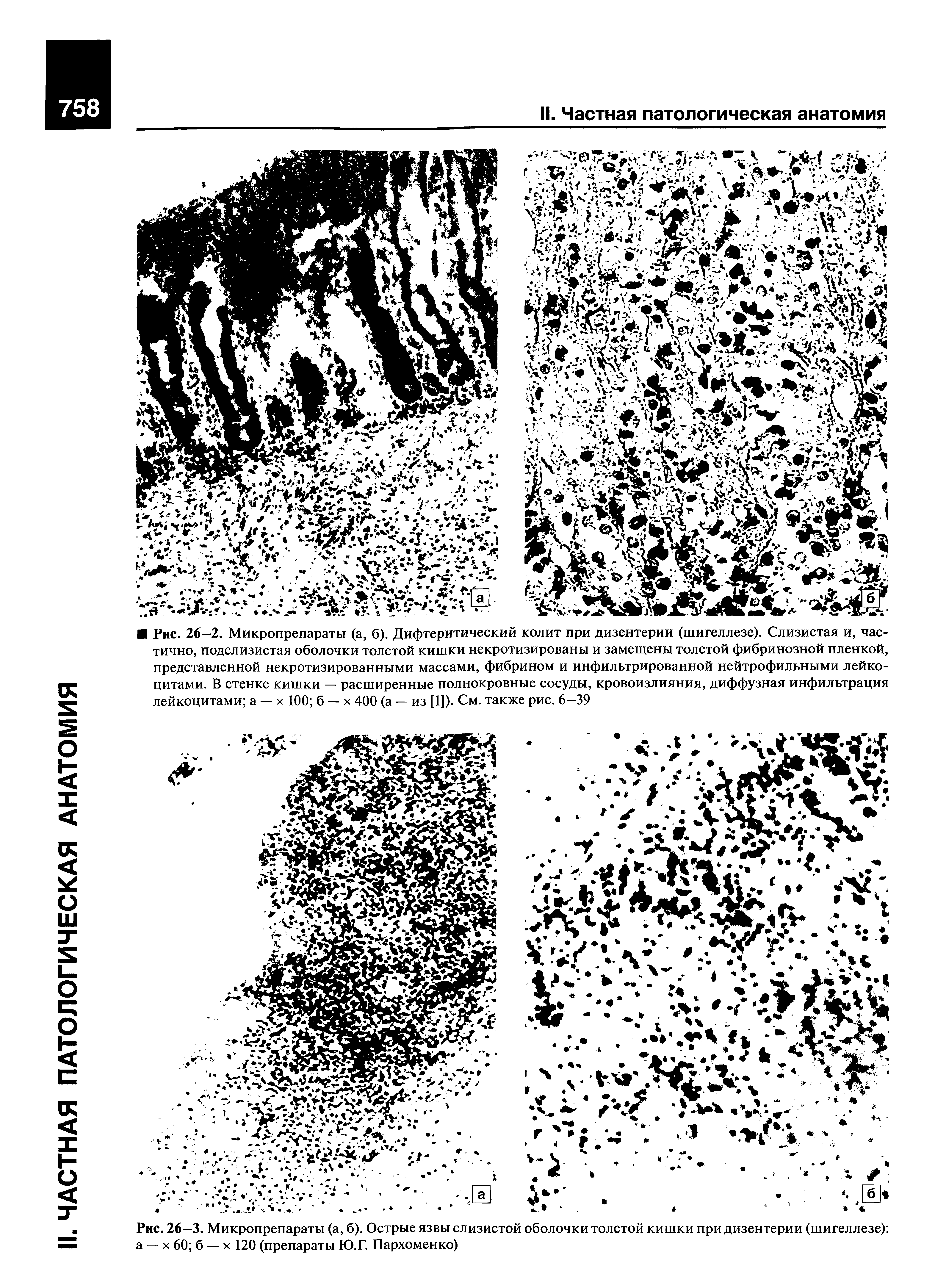 Рис. 26—3. Микропрепараты (а, б). Острые язвы слизистой оболочки толстой кишки при дизентерии (шигеллезе) а — х 60 б — х 120 (препараты Ю.Г. Пархоменко)...