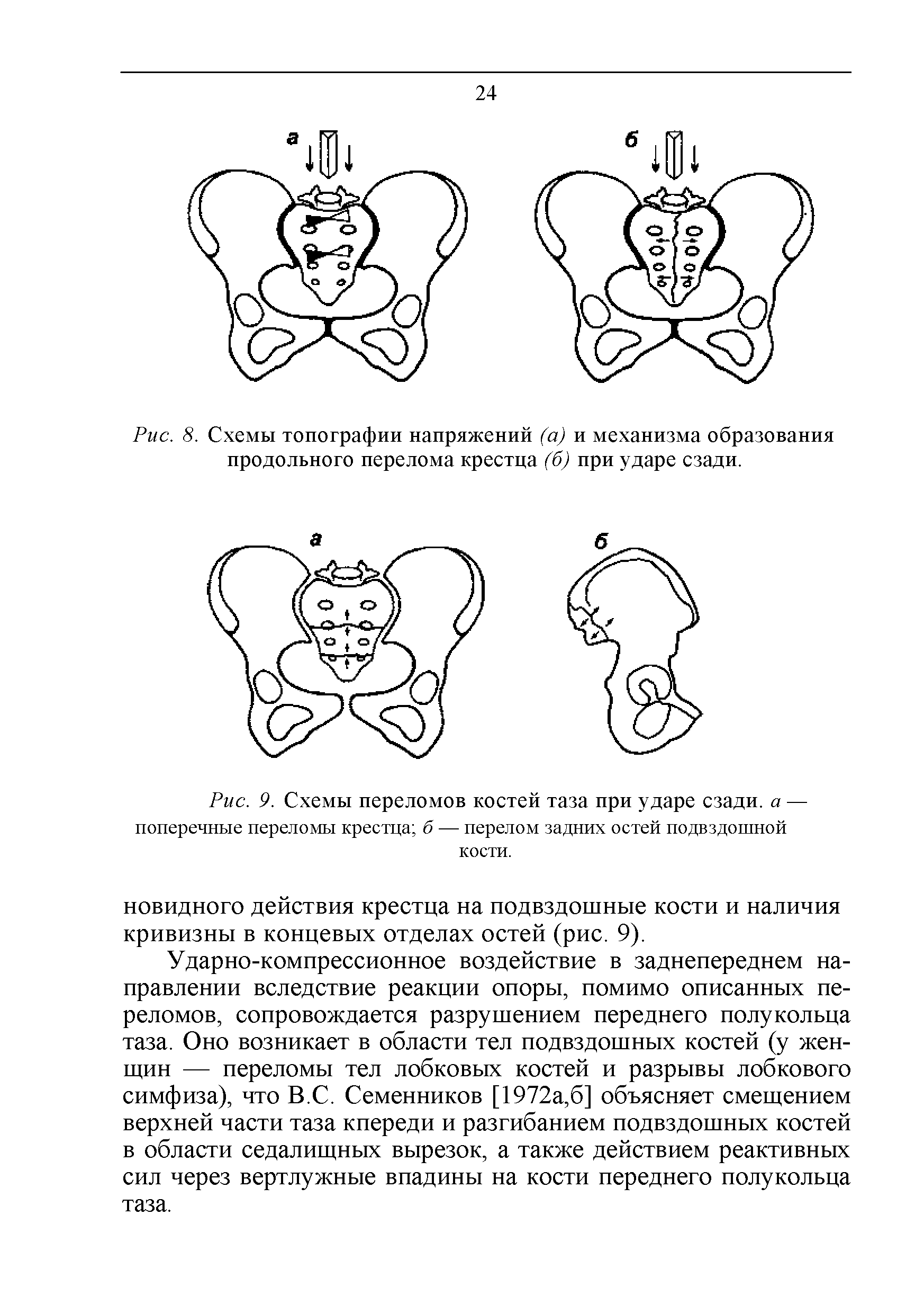 Рис. 9. Схемы переломов костей таза при ударе сзади, а — поперечные переломы крестца б — перелом задних остей подвздошной кости.