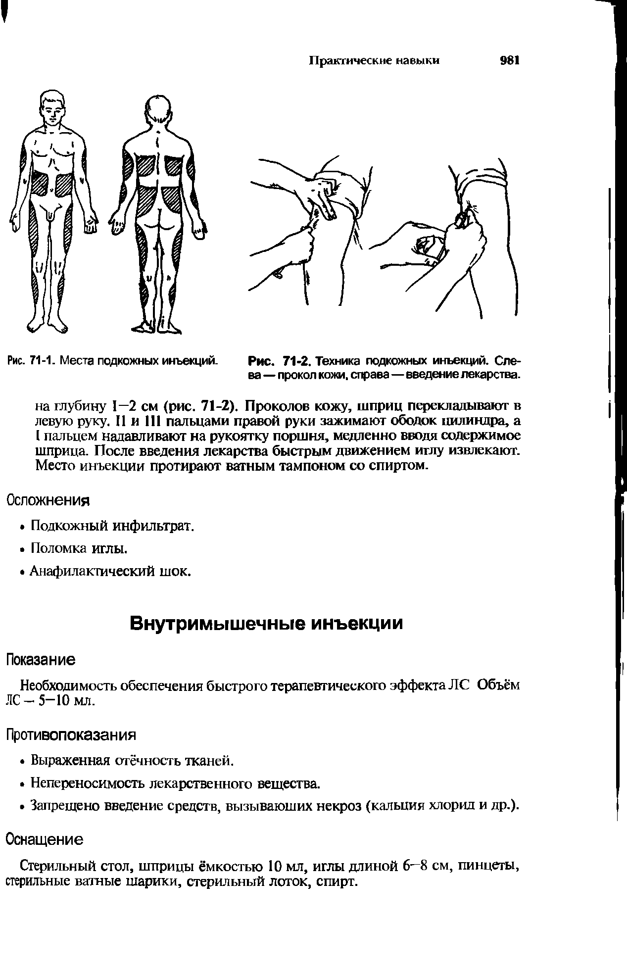 Рис. 71-1. Места подкожных инъекций. Рис. 71-2. Техника подкожных инъекций. Слева — прокол кожи, справа—введение лекарства.