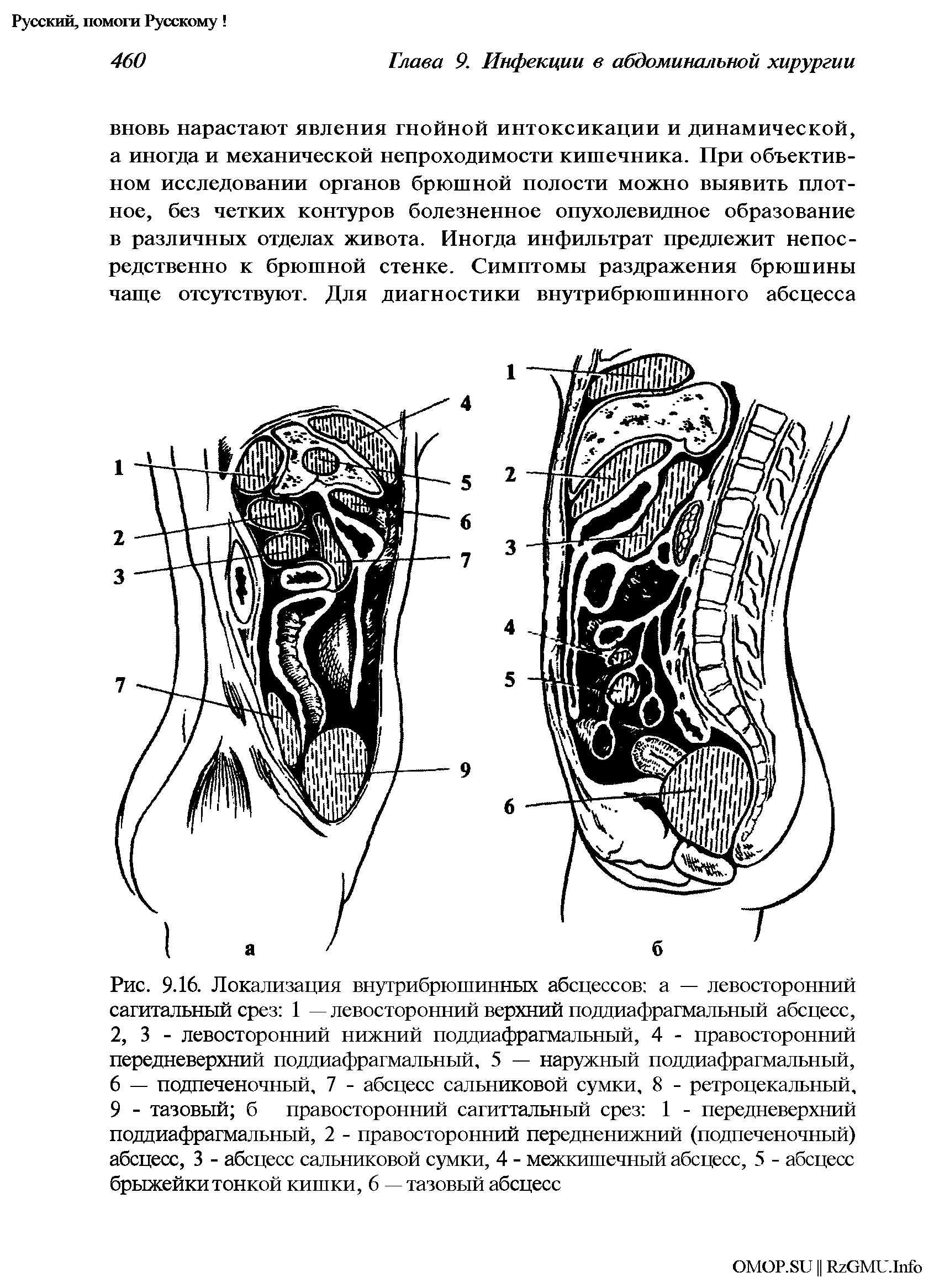 Рис. 9.16. Локализация внутрибрюшинных абсцессов а — левосторонний сагитальный срез 1 — левосторонний верхний поддиафрагмальный абсцесс, 2, 3 - левосторонний нижний поддиафрагмальный, 4 - правосторонний передневерхний поддиафрагмальный, 5 — наружный поддиафрагмальный, 6 — подпеченочный, 7 - абсцесс сальниковой сумки, 8 - ретроцекальный, 9 - тазовый б правосторонний сагиттальный срез 1 - передневерхний поддиафрагмальный, 2 - правосторонний передненижний (подпеченочный) абсцесс, 3 - абсцесс сальниковой сумки, 4 - межкишечный абсцесс, 5 - абсцесс брыжейки тонкой кишки, 6 — тазовый абсцесс...