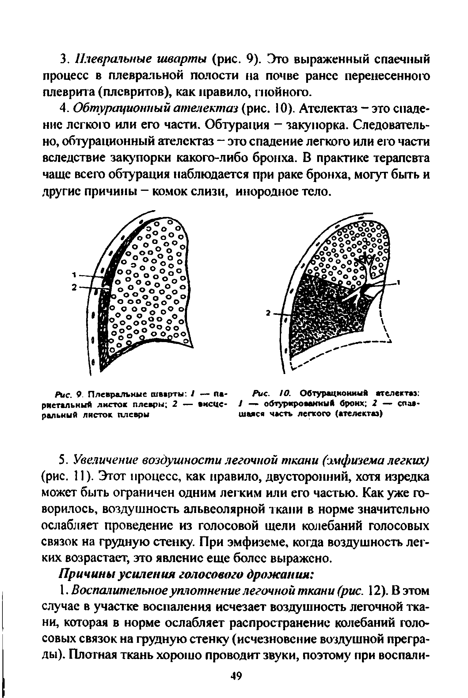 Рис. 9. Плевральные шварты 1 — париетальный листов плевры 2 — висцеральный листок плевры...