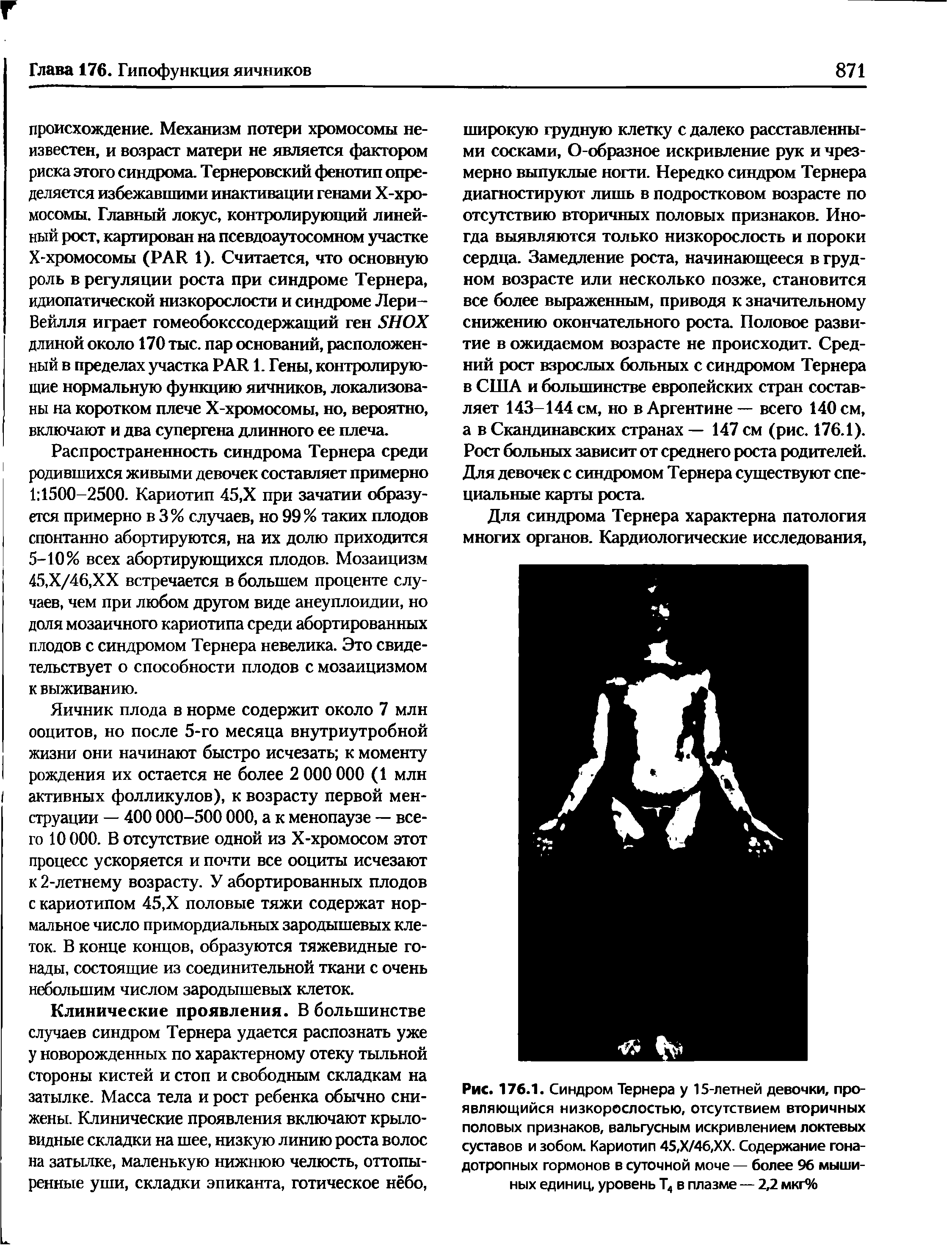Рис. 176.1. Синдром Тернера у 15-летней девочки, проявляющийся низкорослостью, отсутствием вторичных половых признаков, вальгусным искривлением локтевых суставов и зобом. Кариотип 45,Х/4б,ХХ. Содержание гонадотропных гормонов в суточной моче — более 96 мышиных единиц, уровень Т4 в плазме — 2,2 мкг%...