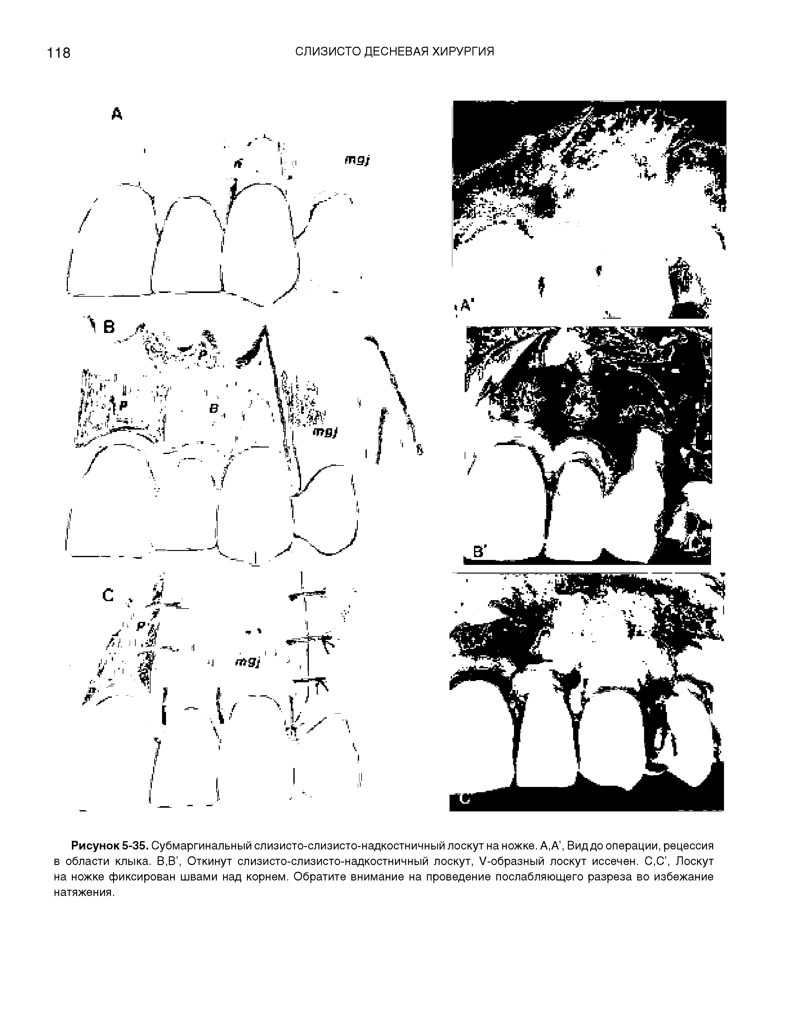 Рисунок 5-35. Субмаргинальный слизисто-слизисто-надкостничный лоскут на ножке. А,А, Вид до операции, рецессия в области клыка. В,В, Откинут слизисто-слизисто-надкостничный лоскут, У-образный лоскут иссечен. С,С, Лоскут на ножке фиксирован швами над корнем. Обратите внимание на проведение послабляющего разреза во избежание...