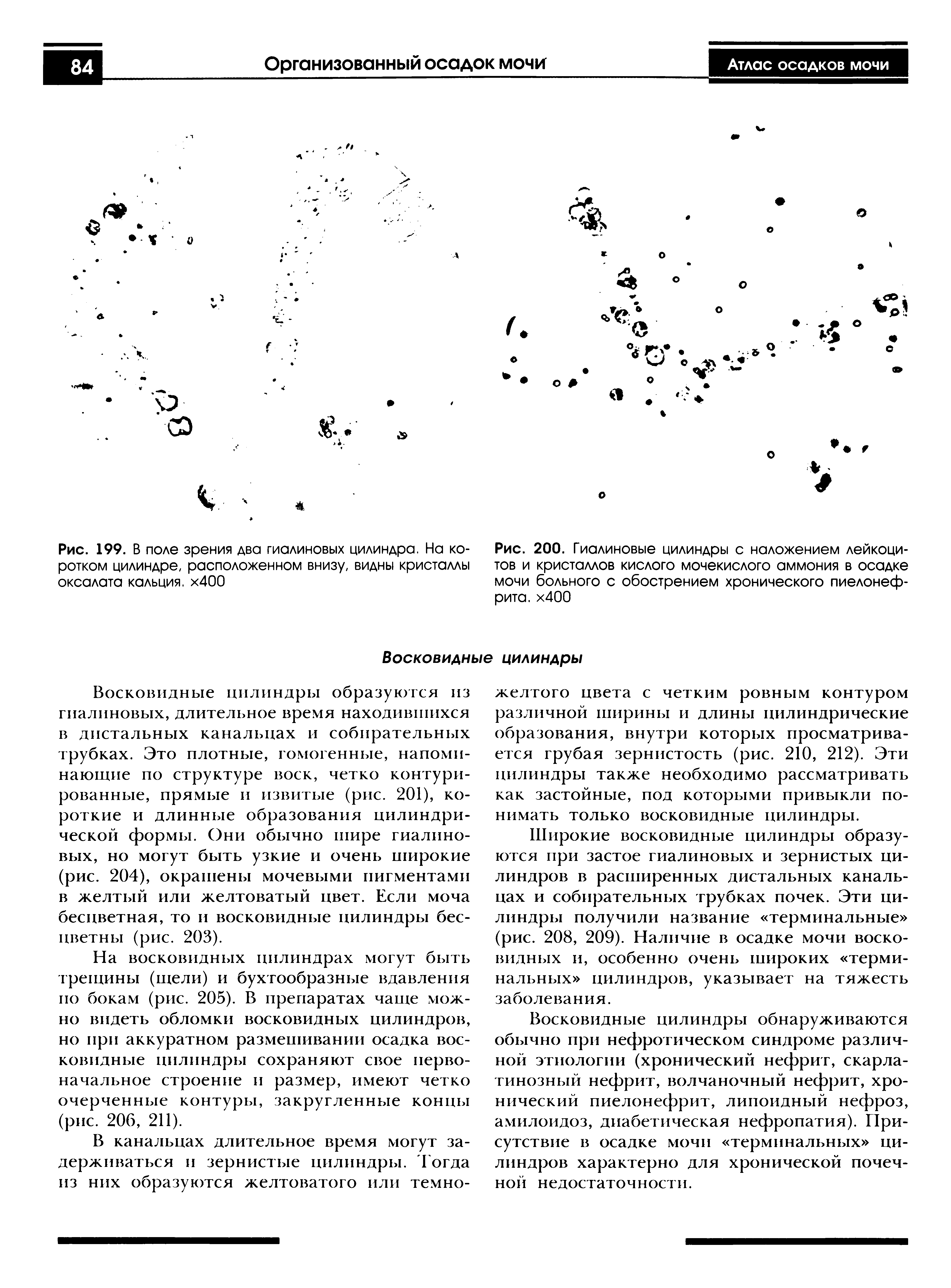 Рис. 200. Гиалиновые цилиндры с наложением лейкоцитов и кристаллов кислого мочекислого аммония в осадке мочи больного с обострением хронического пиелонефрита. х400...