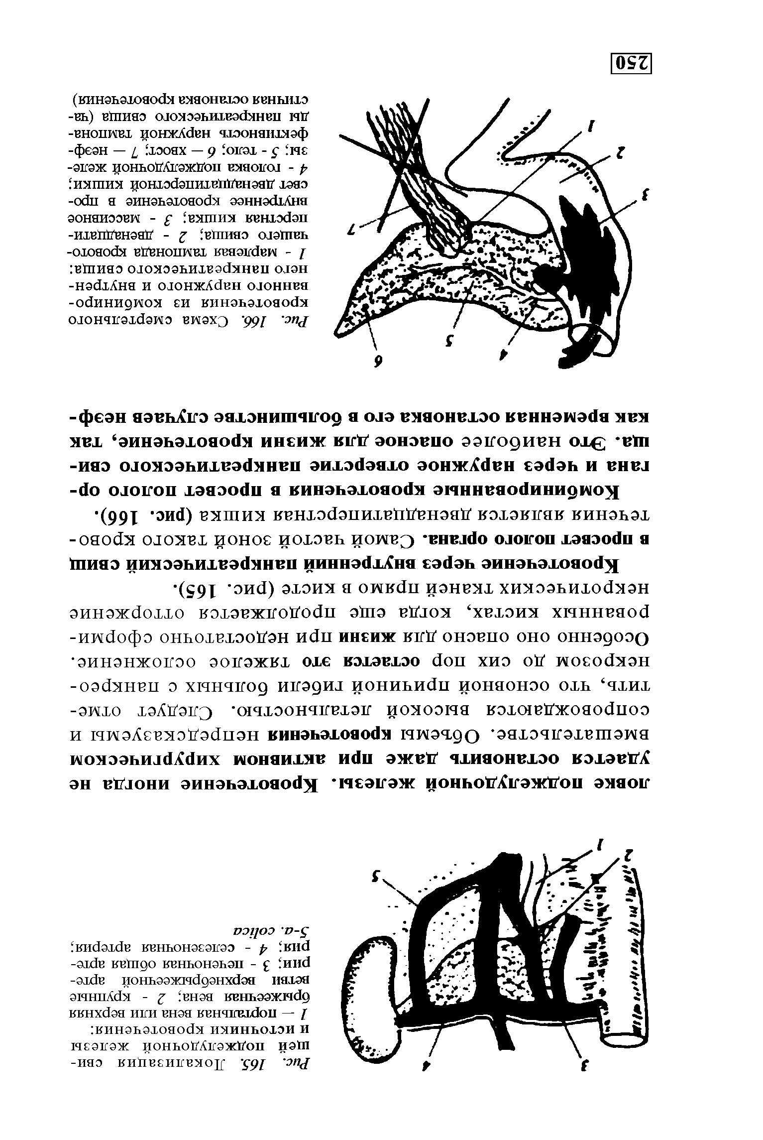 Рис. 166. Схема смертельного кровотечения из комбинированного наружного и внутреннего панкреатического свища 1 - марлевая тампонада кровоточащего свища 2 - двенадцатиперстная кишка 3 - массивное внутреннее кровотечение в просвет двенадцатиперстной кишки 4 - головка поджелудочной железы 5 - тело 6 — хвост 7 — неэффективность наружной тампонады панкреатического свища (частичная остановка кровотечения)...