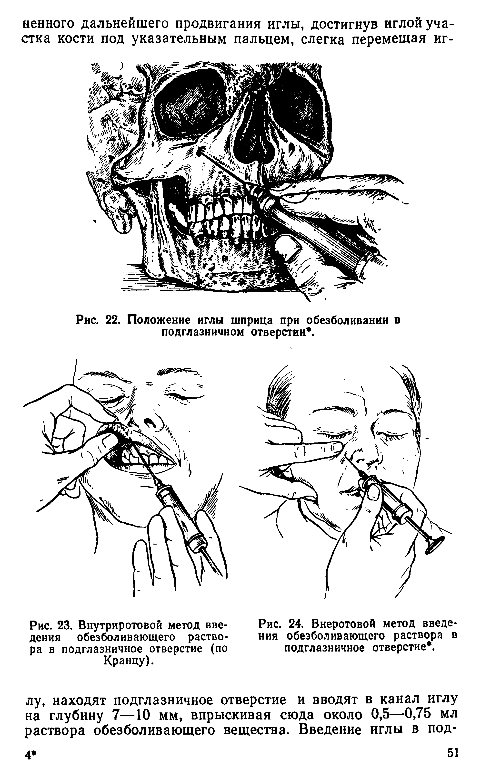 Рис. 23. Внутриротовой метод введения обезболивающего раствора в подглазничное отверстие (по Кранцу).