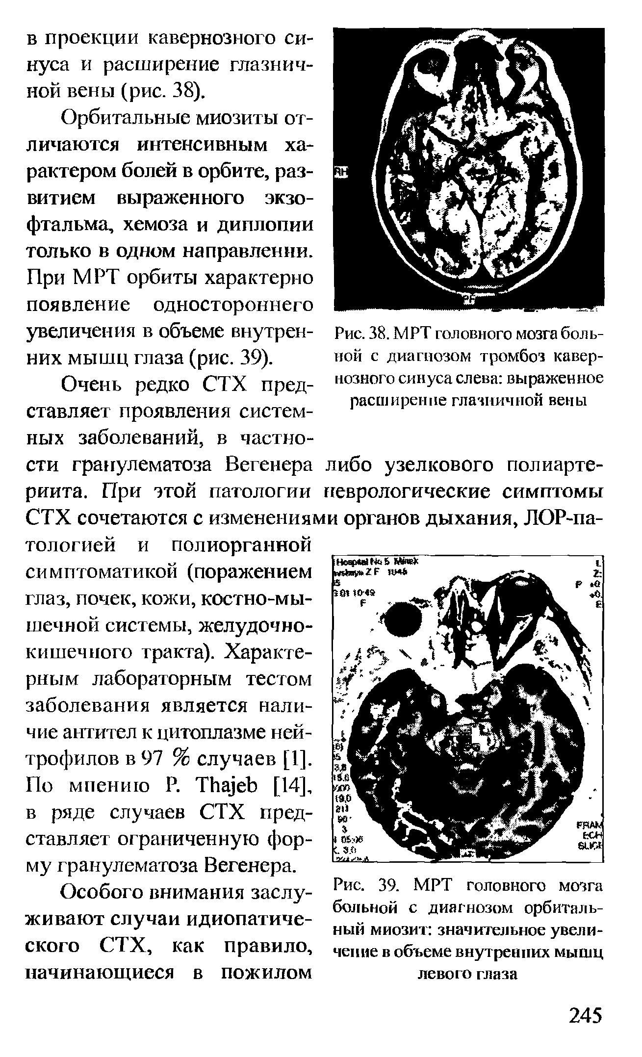 Рис. 39. МРТ головного мозга больной с диагнозом орбитальный миозит значительное увеличение в объеме внутренних мышц левого глаза...