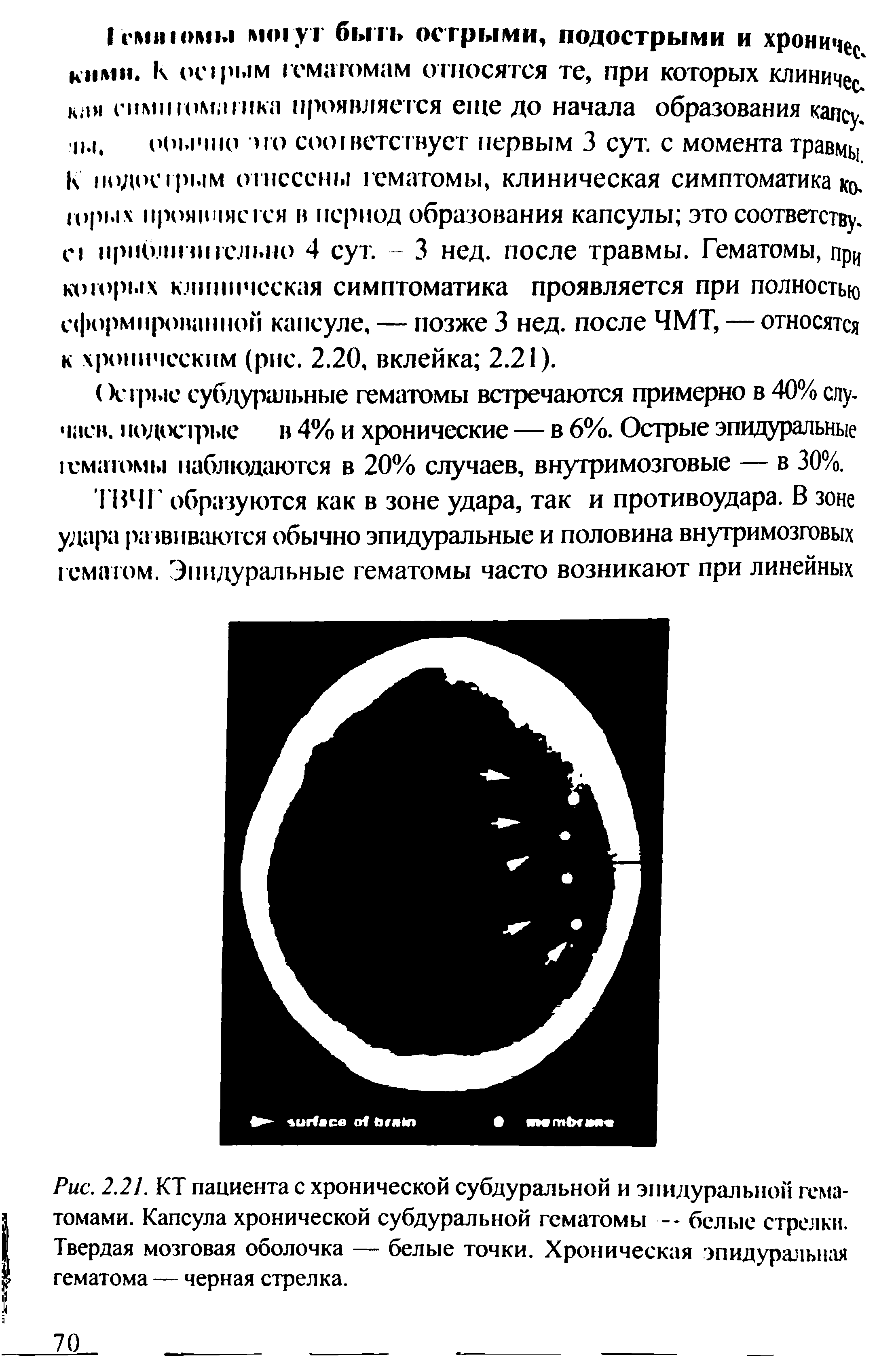 Рис. 2.21. КТ пациента с хронической субдуральной и эпидуральной гематомами. Капсула хронической субдуральной гематомы — белые стрелки. Твердая мозговая оболочка — белые точки. Хроническая эпидуральная гематома — черная стрелка.