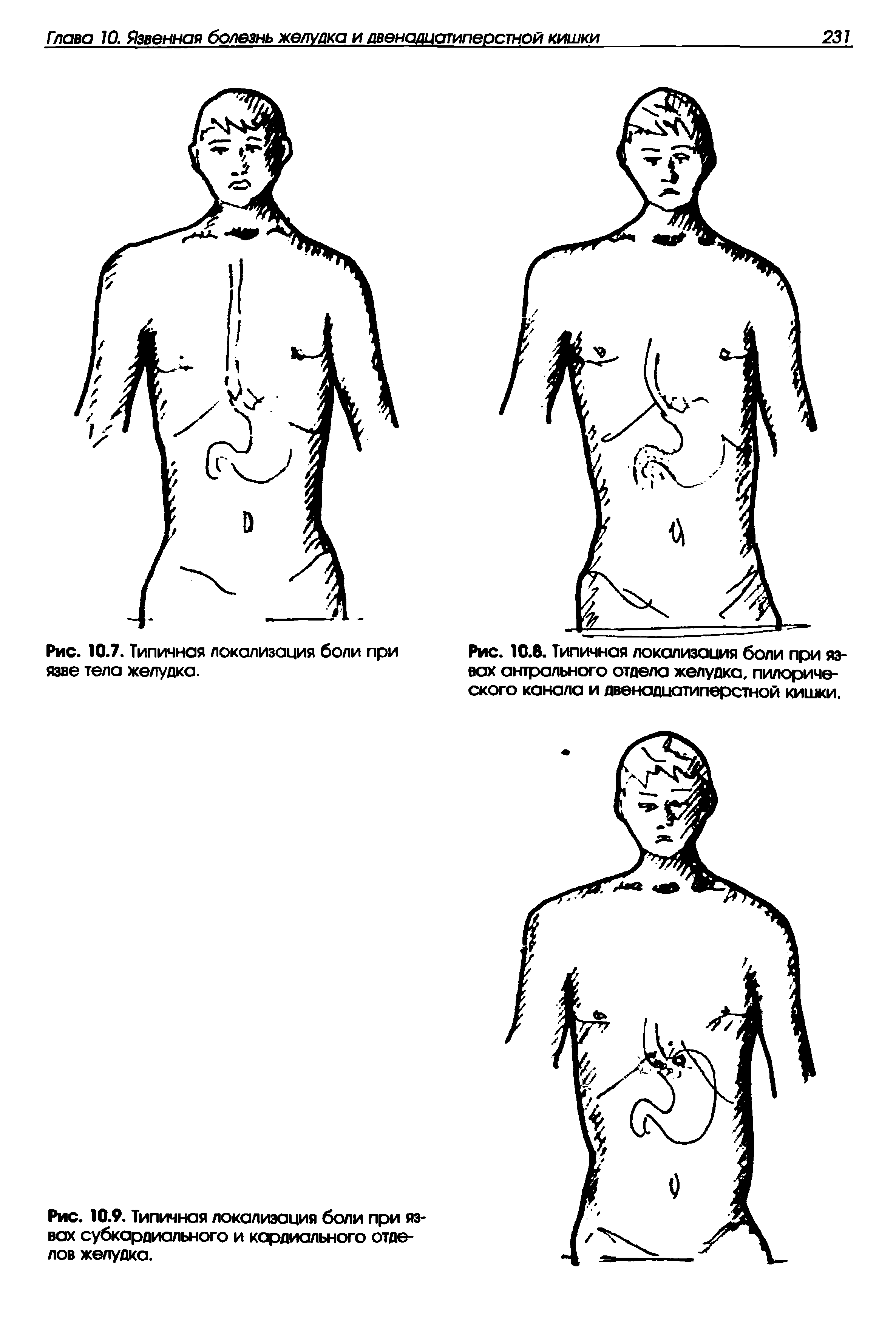 Рис. 10.8. Типичная локализация боли при язвах антрального отдела желудка, пилорического канала и двенадцатиперстной кишки.