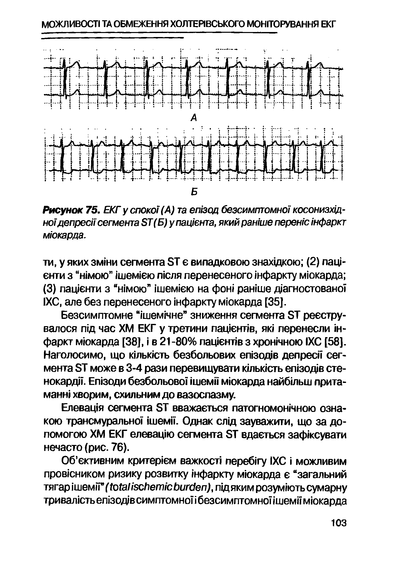 Рисунок 75. ЕКГ у споко1 (А) та егнзод безсимптомно косонизхщ-ноИдепресн сегмента 5Т(Б)у патента, який ран/ше перен/с нфаркт мюкарда.