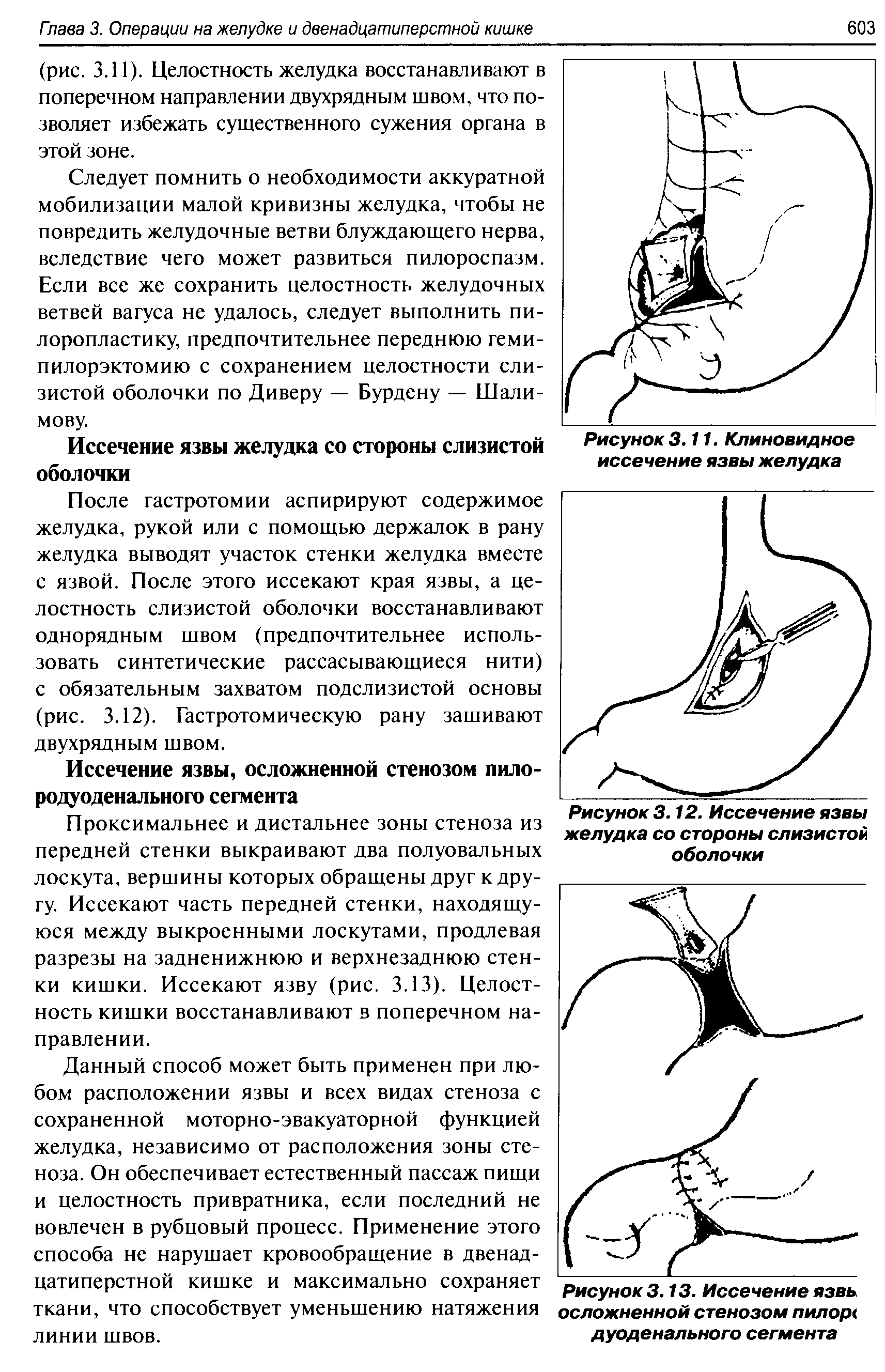 Рисунок 3.13. Иссечение язвь осложненной стенозом пилор< дуоденального сегмента...