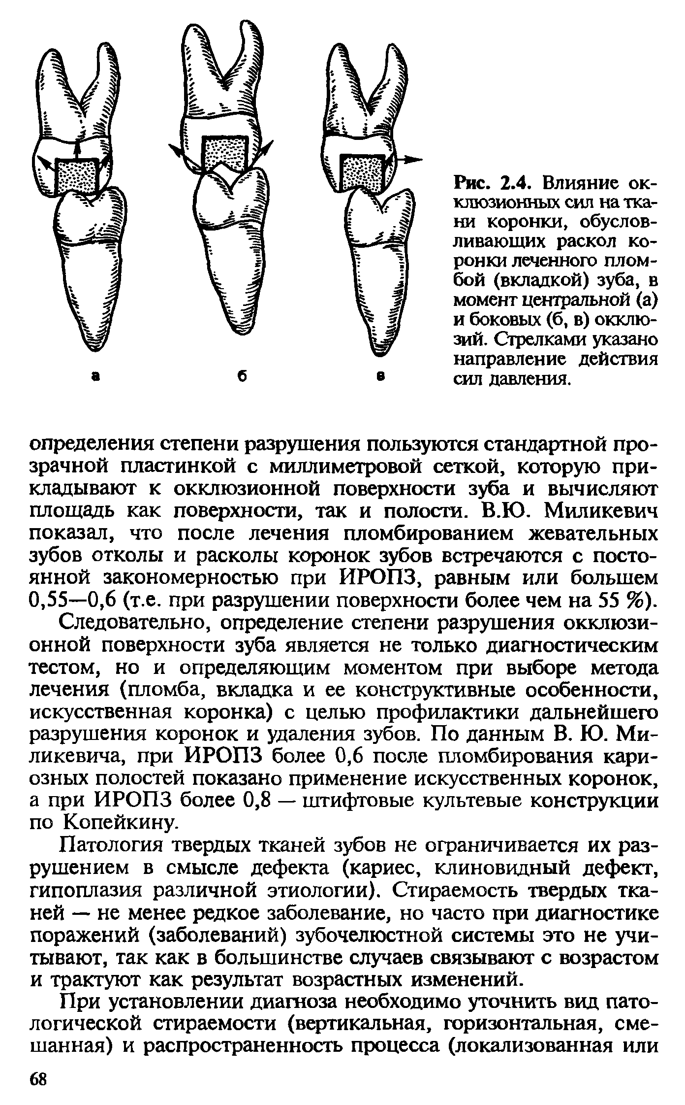 Рис. 2.4. Влияние окклюзионных сил на ткани коронки, обусловливающих раскол коронки леченного пломбой (вкладкой) зуба, в момент центральной (а) и боковых (б, в) окклюзий. Стрелками указано направление действия сил давления.