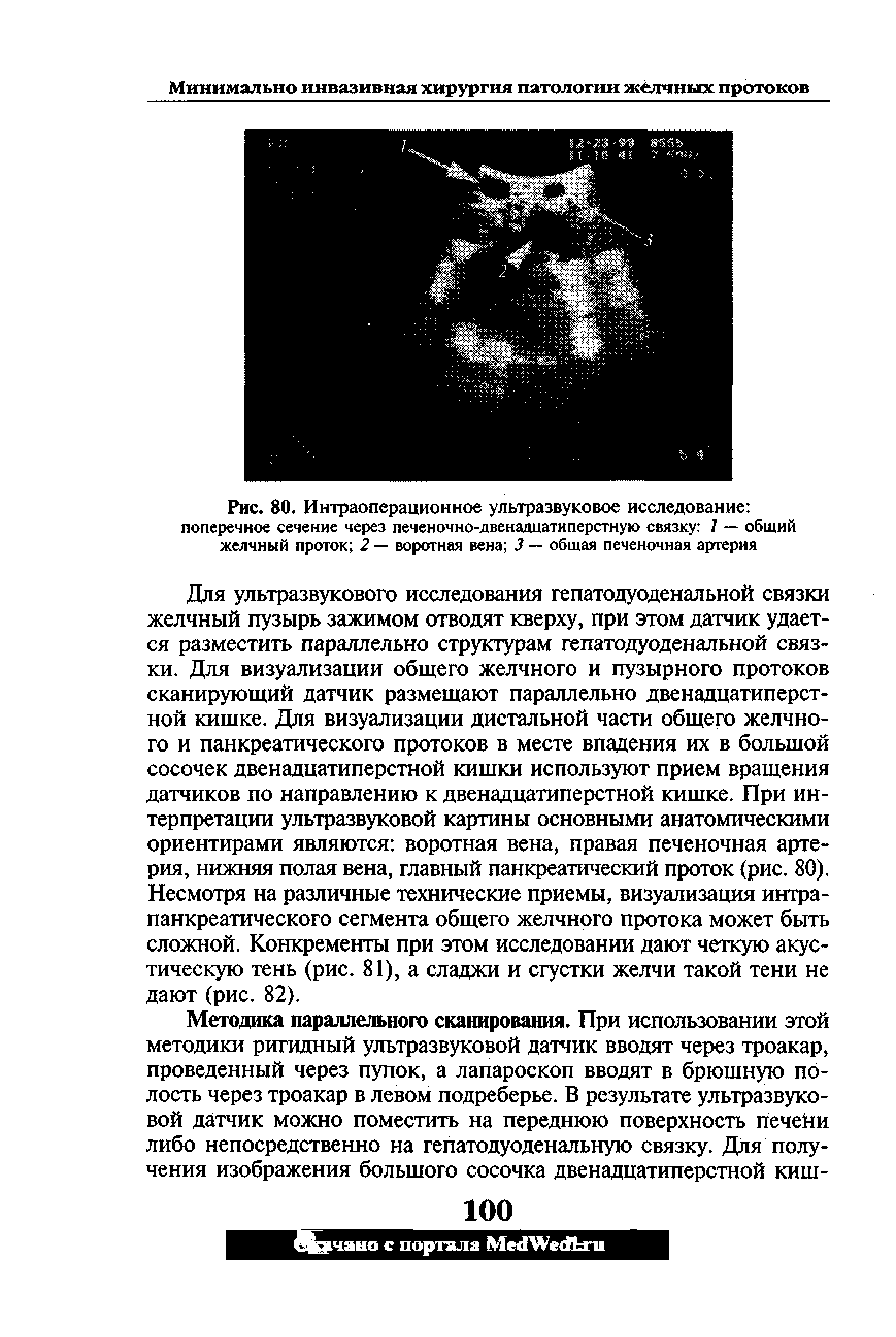 Рис. 80. Интраоперационное ультразвуковое исследование поперечное сечение через печеночно-двенадцатиперстную связку 1 — общий желчный проток 2 — воротная вена 3 — общая печеночная артерия...