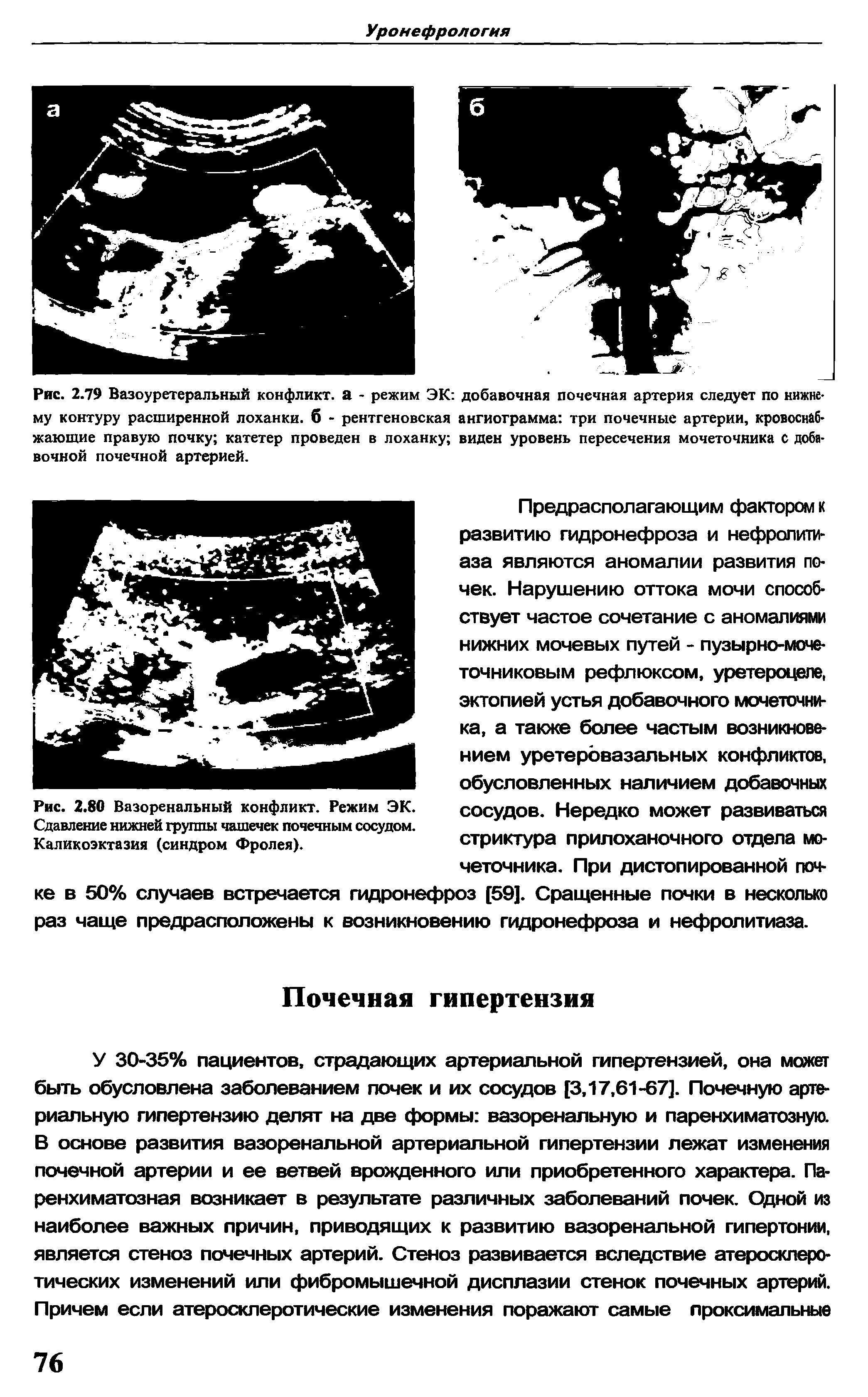 Рис. 2.80 Вазоренальный конфликт. Режим ЭК. Сдавление нижней группы чашечек почечным сосудом. Каликоэктазия (синдром Фролея).