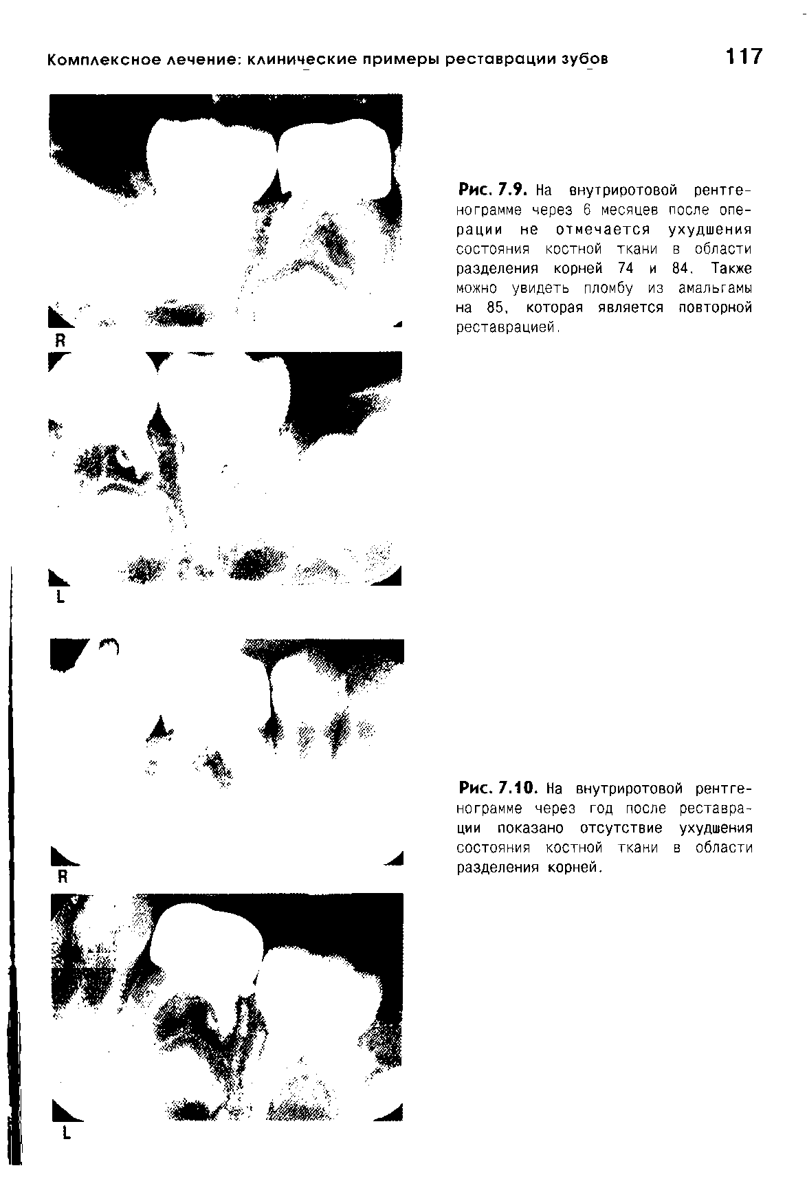 Рис. 7.9. На енутриротовой рентгенограмме через 6 месяцев после операции не отмечается ухудшения состояния костной ткани в области разделения корней 74 и 84. Также можно увидеть пломбу из амальгамы на 85. которая является повторной реставрацией.