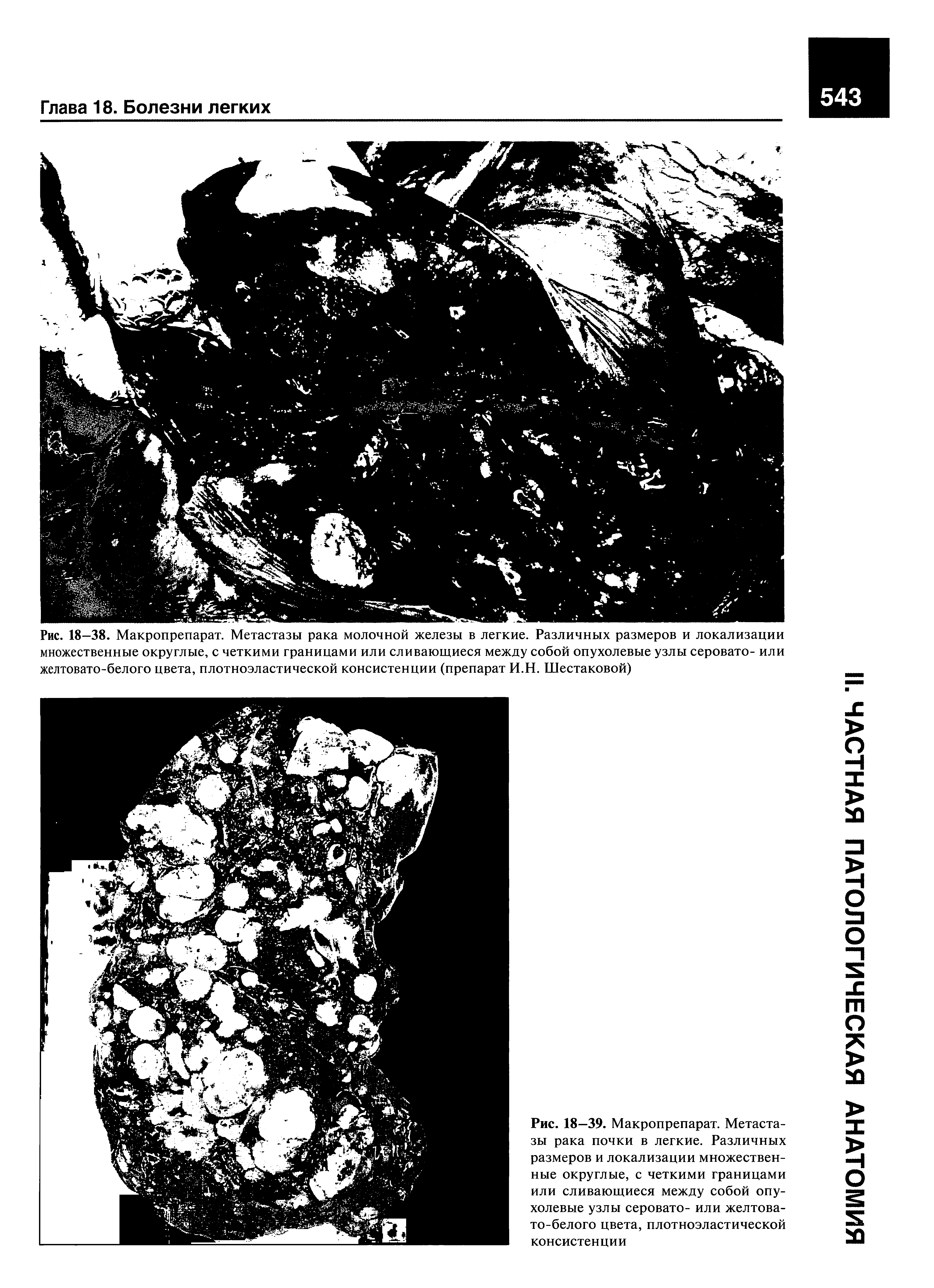 Рис. 18—39. Макропрепарат. Метастазы рака почки в легкие. Различных размеров и локализации множественные округлые, с четкими границами или сливающиеся между собой опухолевые узлы серовато- или желтовато-белого цвета, плотноэластической консистенции...