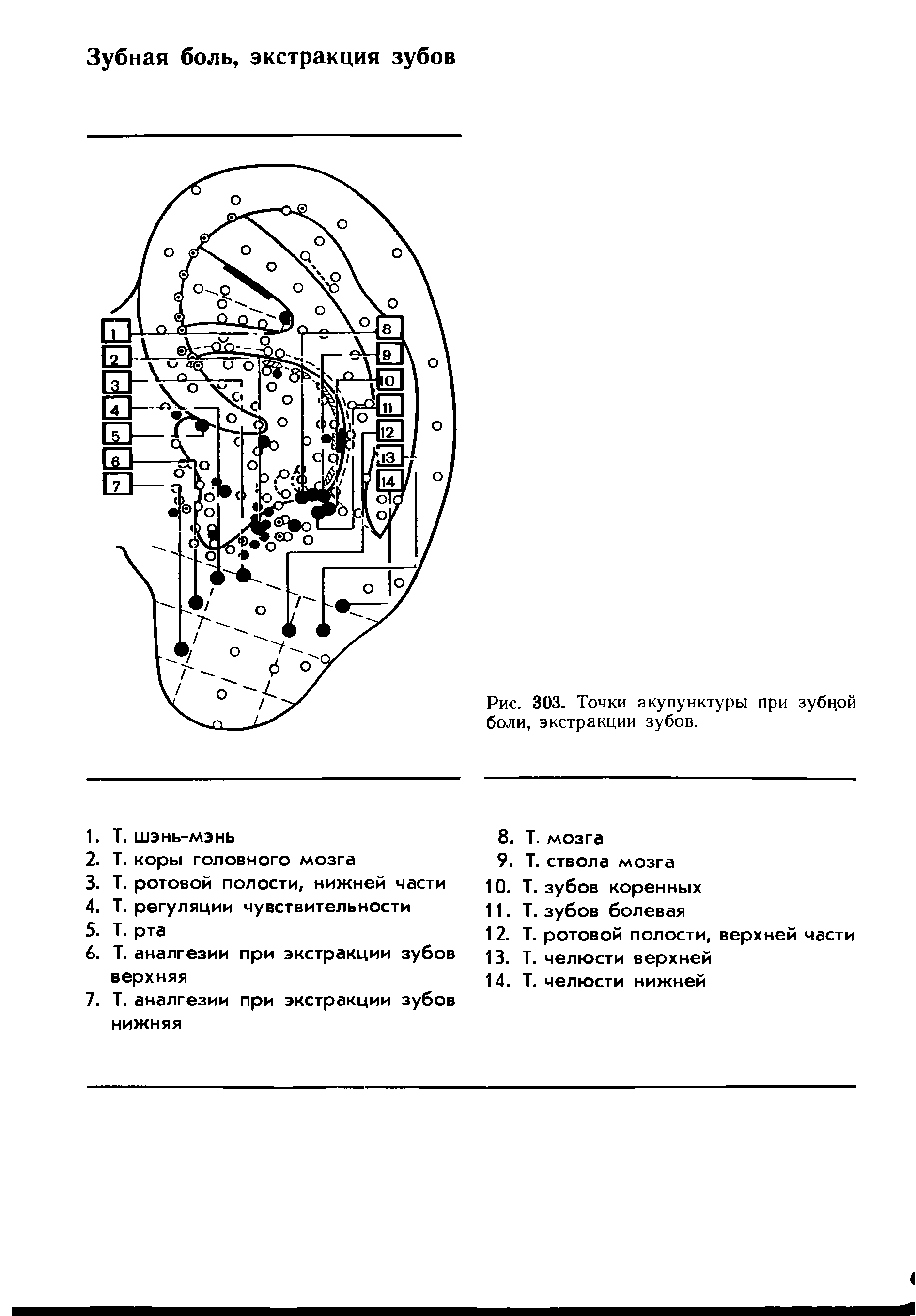 Рис. 303. Точки акупунктуры при зубной боли, экстракции зубов.