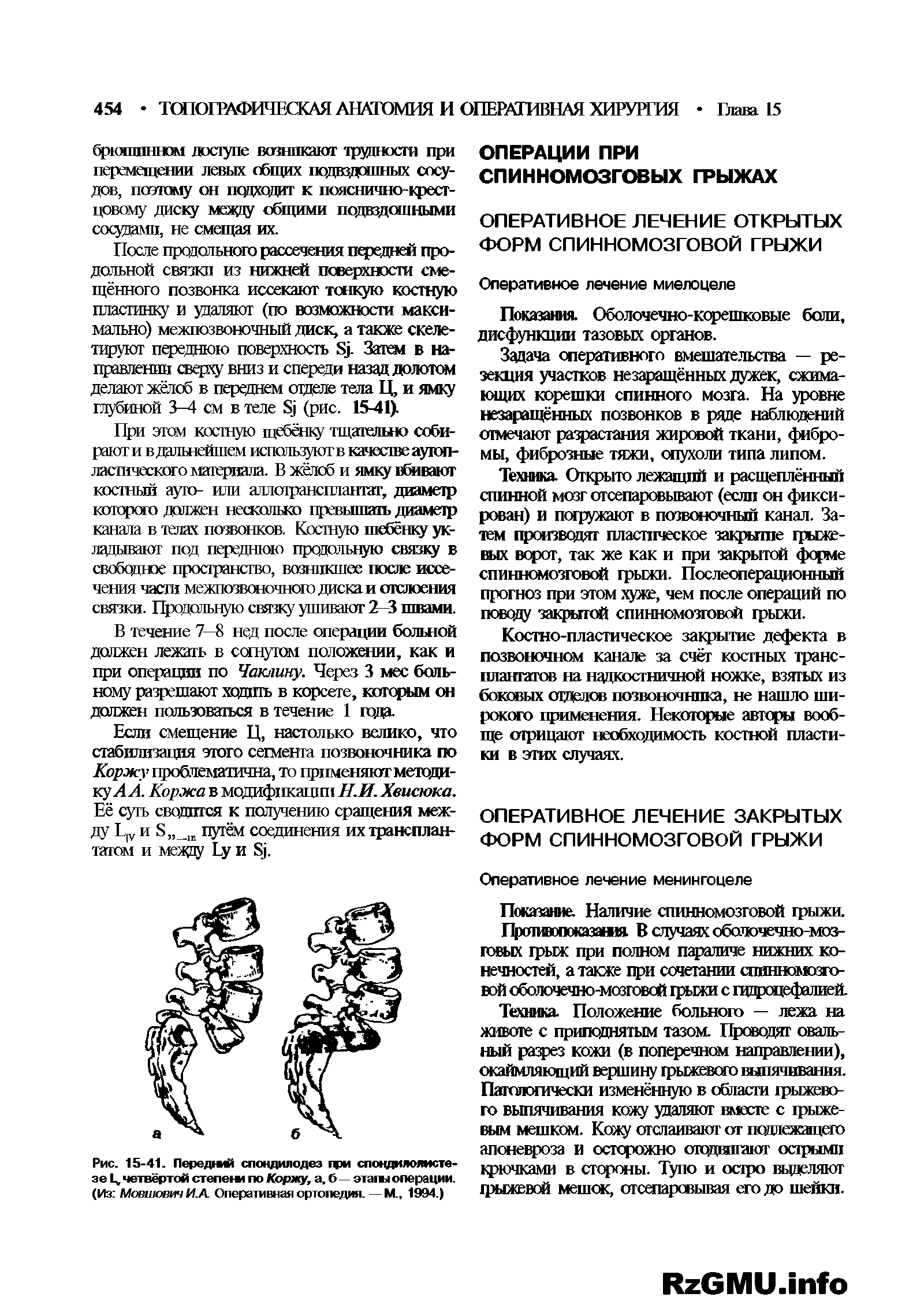 Рис. 15-41. ПередмА спондилодез гфи спондилолистезе Ц, четвёртой степени по Коржу, а, б — этагы операции. (Из Мовиювич ИЛ Оперативная ортопедия. — М., 1994.)...