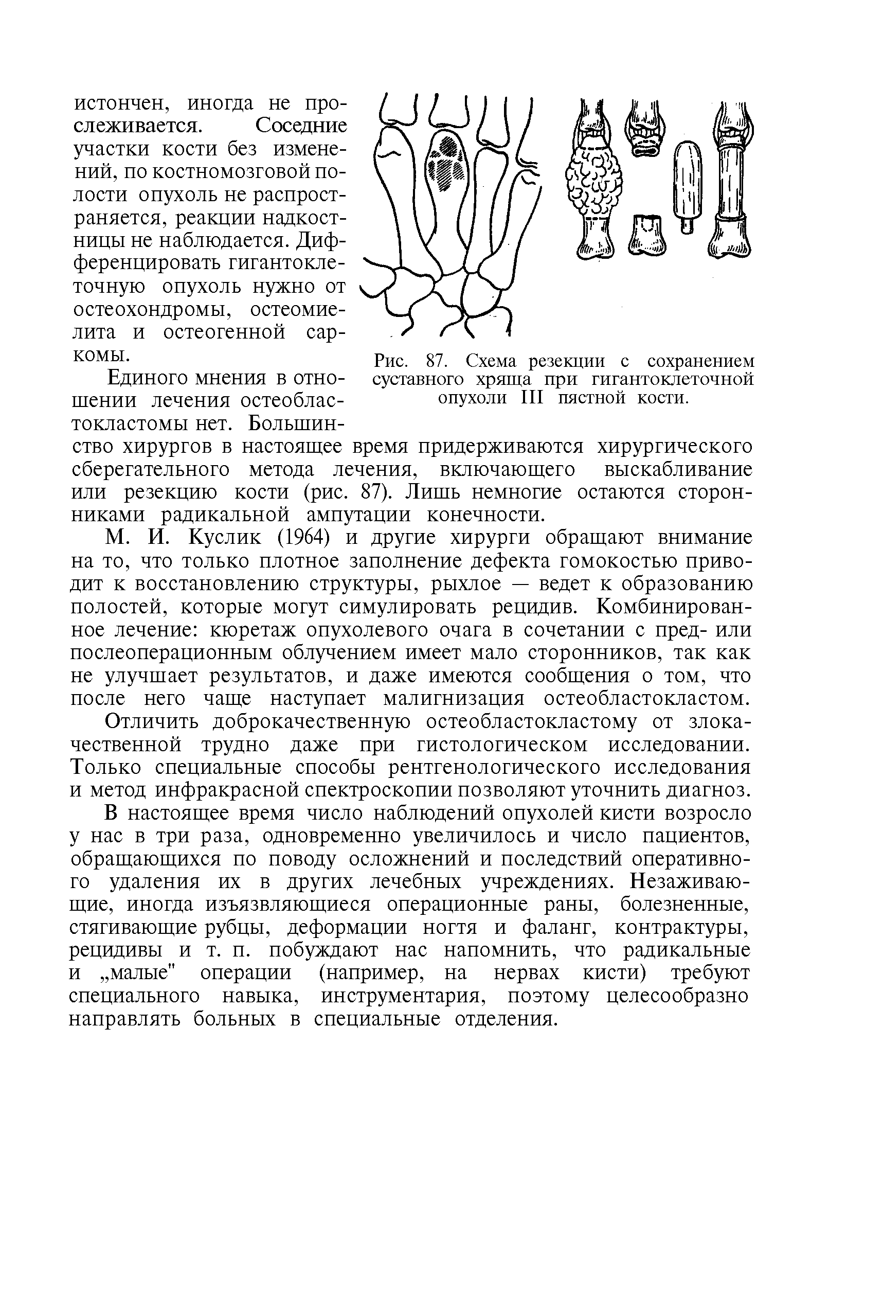 Рис. 87. Схема резекции с сохранением суставного хряща при гигантоклеточной опухоли III пястной кости.