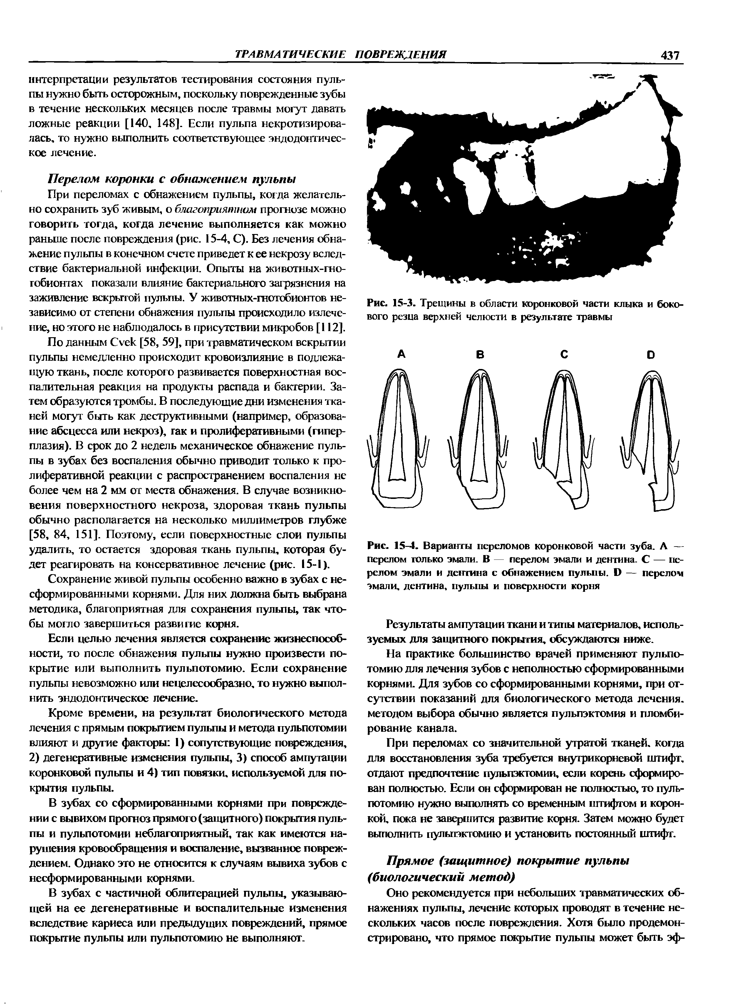 Рис. 15-4. Варианты переломов коронковой части зуба. А — перелом только эмали. В — перелом эмали и дентина. С — перелом эмали и дентина с обнажением пульпы. Б — перелом эмали, дентина, пульпы и поверхности корня...