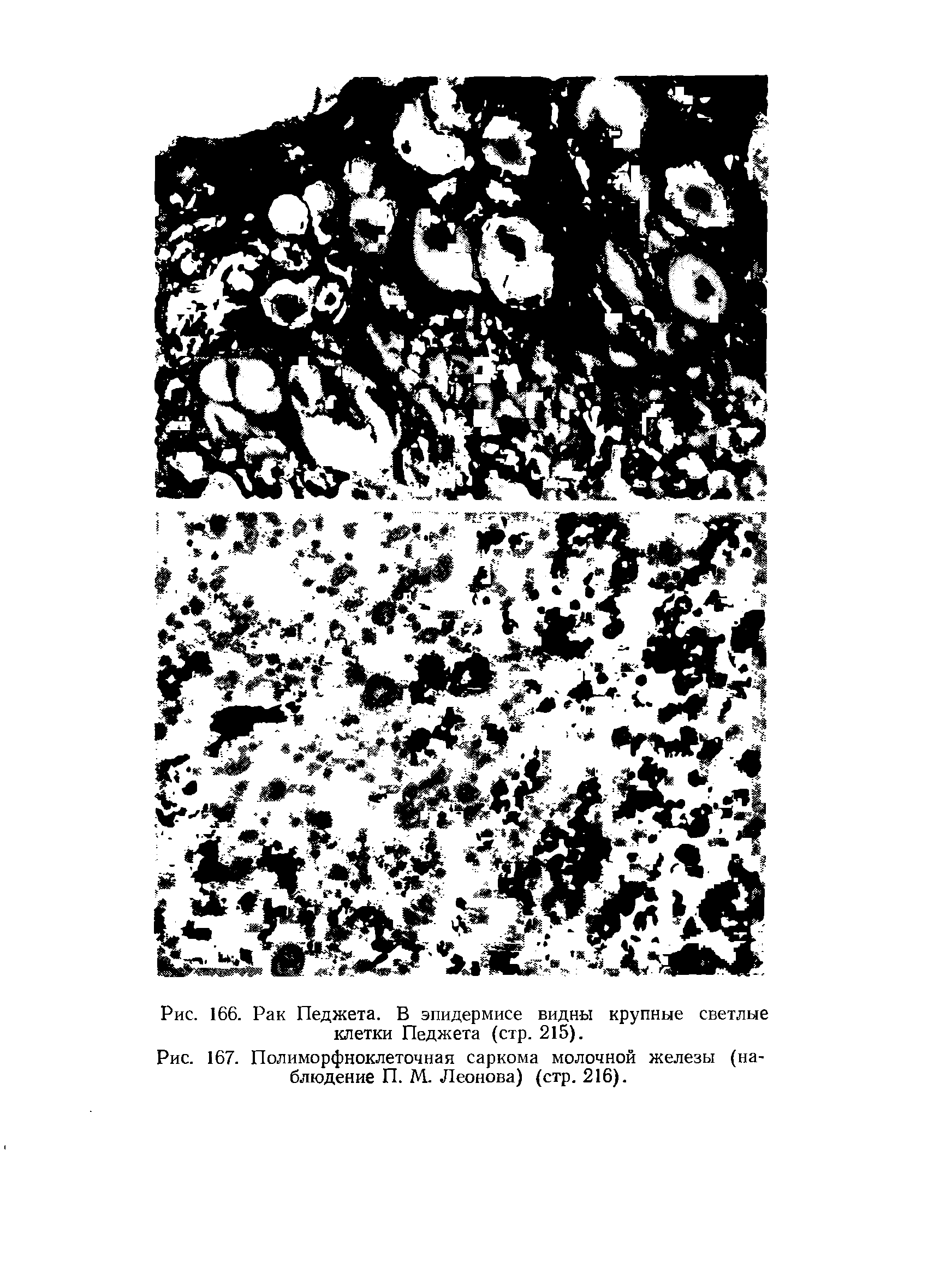 Рис. 167. Полиморфноклеточная саркома молочной железы (наблюдение П. М. Леонова) (стр. 216).