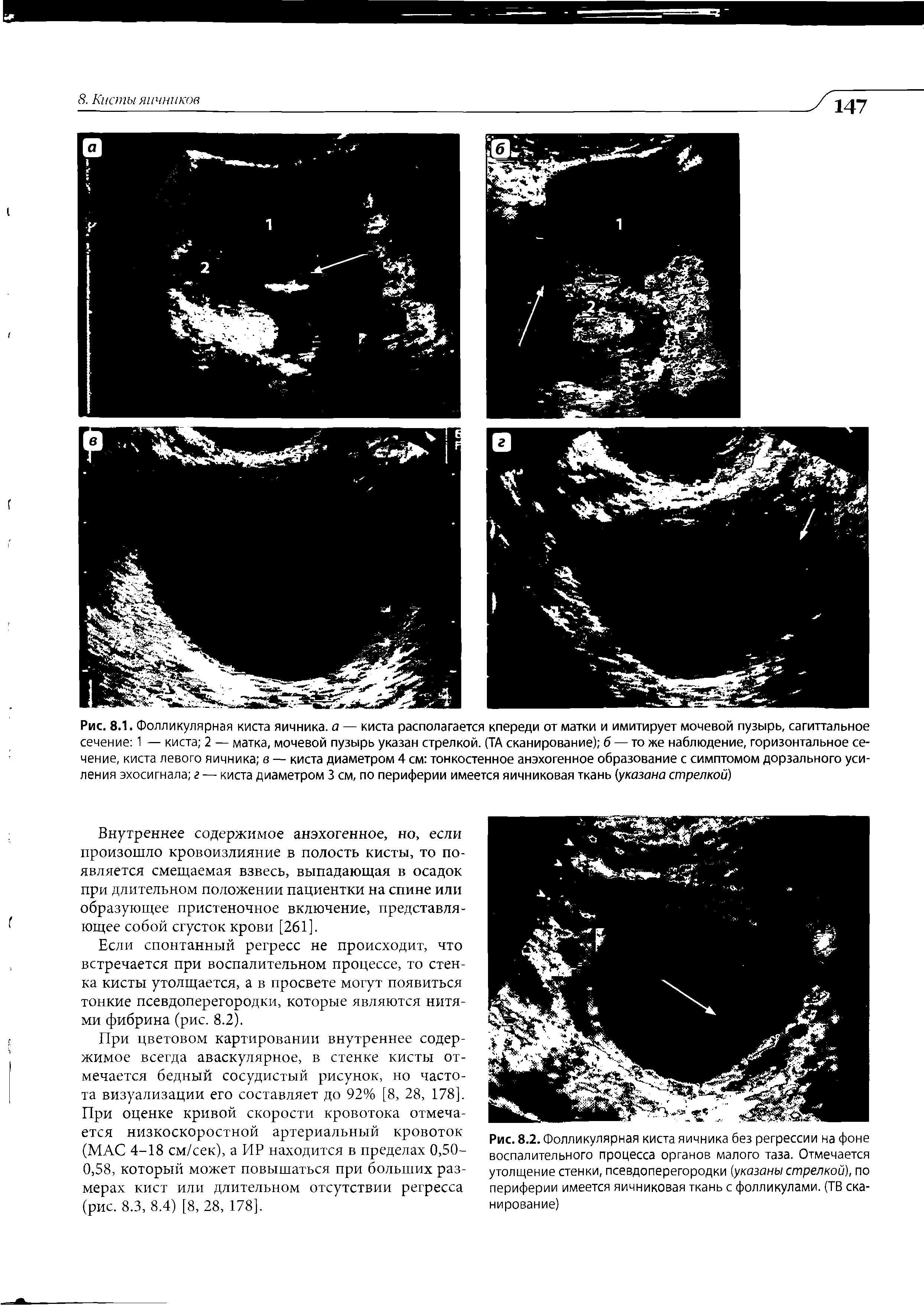 Рис. 8.2. Фолликулярная киста яичника без регрессии на фоне воспалительного процесса органов малого таза. Отмечается утолщение стенки, псевдоперегородки (указаны стрелкой), по периферии имеется яичниковая ткань с фолликулами. (ТВ сканирование)...