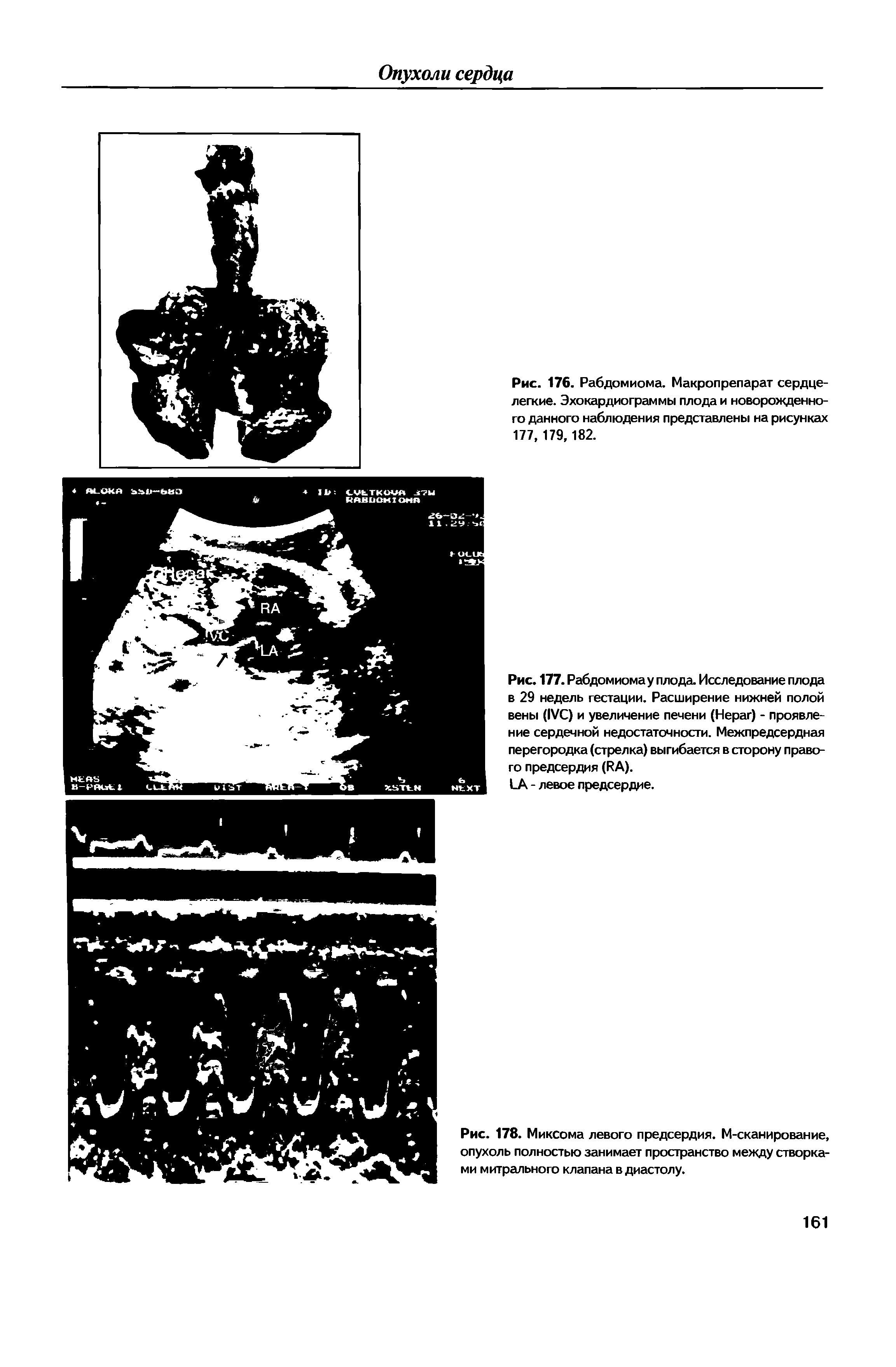 Рис. 177. Рабдомиома у плода. Исследование плода в 29 недель гестации. Расширение нижней полой вены (IVC) и увеличение печени (H ) - проявление сердечной недостаточности. Межпредсердная перегородка (стрелка) выгибается в сторону правого предсердия (RA).